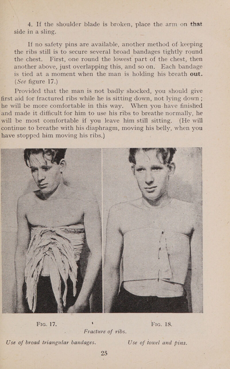 4. If the shoulder ae is broken, place the. arm on that side in a Sling. If no safety pins are available, another method of. keeping the ribs still is to secure several broad bandages tightly round the chest. First, one round the lowest part of the chest, then another above, just overlapping this, and so on. Each bandage is tied at a moment when the man is HOS his breath out. (See figure 17.) Provided that the man is not badly shocked, you should give first aid for fractured ribs while he is sitting down, not lying down ; he will be more comfortable in this way. When you-have finistied and made it difficult for him to use his ribs to breathe normally, he will be most comfortable if you leave him still sitting. (He will continue to breathe with his diaphragm, moving his belly, when you have stopped him moving his ribs.)  Use of broad triangular bandages. Use of towel and pins.