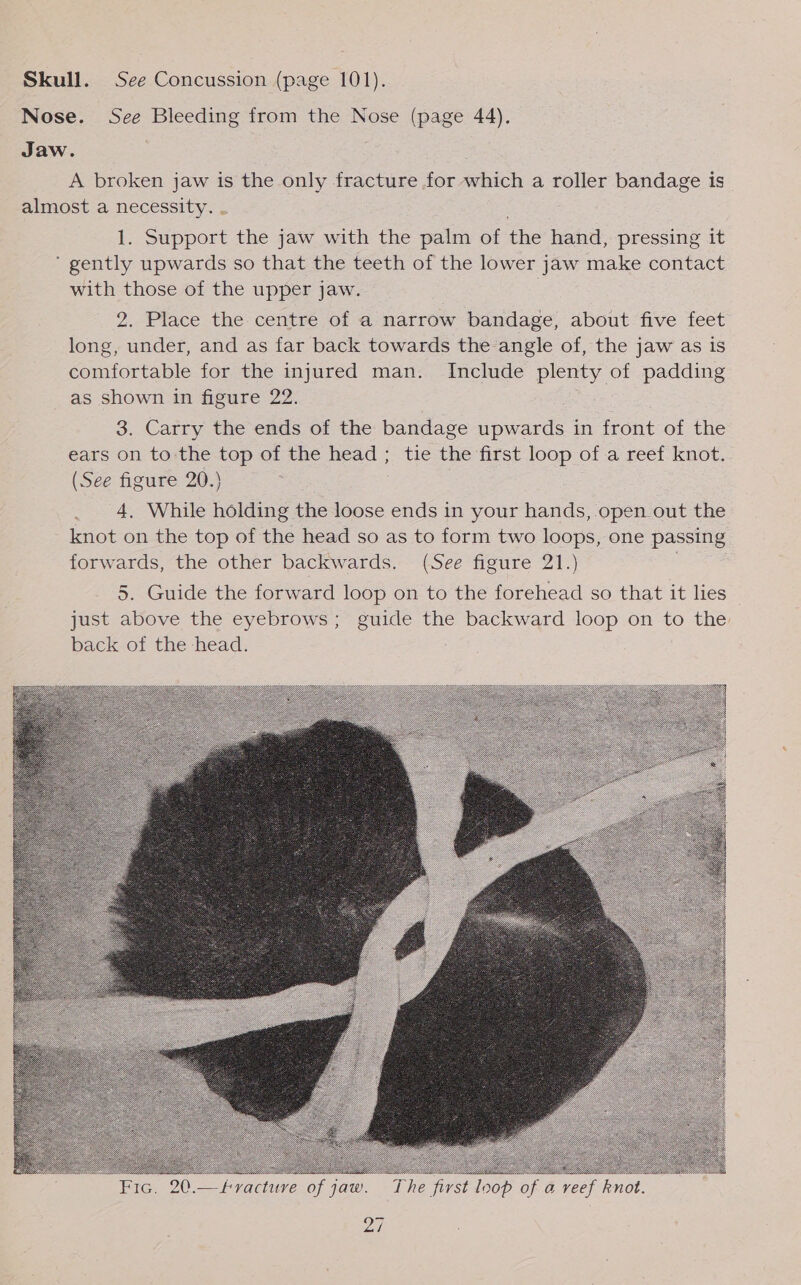 Skull. See Concussion (page 101). Nose. See Bleeding from the Nose (page 44), Jaw. A broken jaw is the only fracture for which a roller bandage is almost a necessity. 1. Support the jaw with the palm of the hand, pressing it gently upwards so that the teeth of the lower jaw make contact with those of the upper jaw. 2. Place the centre of a narrow bandage, about five feet long, under, and as far back towards the angle of, the jaw as is comfortable for the injured man. Include plenty of padding as shown in figure 22. 3. Carry the ends of the bandage upwards in front of the ears on to the top of the head ; tie the first loop of .a reef knot. (See figure 20.} 4, While holding the loose ends in your hands, open out the knot on the top of the head so as to form two loops, one passing forwards, the other backwards. (See figure 21.) 5. Guide the forward loop on to the forehead so that it lies just above the eyebrows; guide the backward loop on to the back of the head.   Fic. 20.— Fracture of jaw. The first loop of a reef knot.