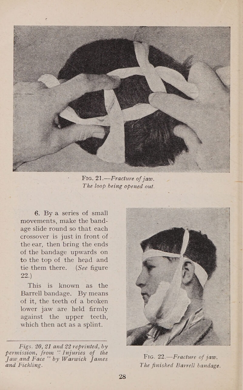  6. By a series of small movements, make the band- age slide round so that each crossover is just in front of the ear, then bring the ends of the bandage upwards on to the top of the head and tie.them there. (See figure 22;) This is known as the Barrell bandage. By means of it, the teeth of a broken lower jaw are held firmly against the upper teeth, which then act as a splint.  Figs. 20, 21 and 22 reprinted, by 