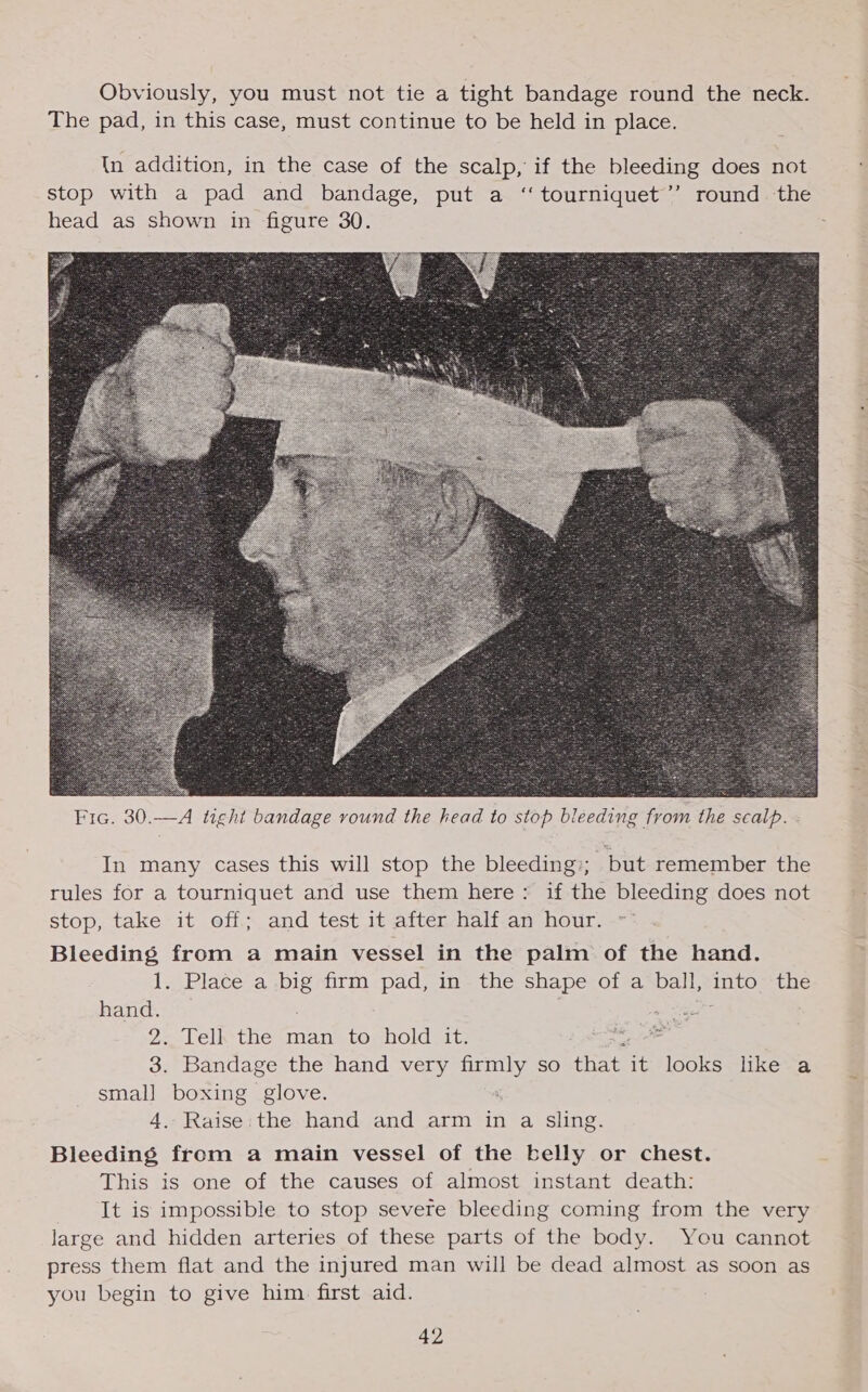 Obviously, you must not tie a tight bandage round the neck. The pad, in this case, must continue to be held in place. In addition, in the case of the scalp, if the bleeding does not stop with a pad and bandage, put a ‘“ tourniquet’”’ round the head as shown in figure 30. ;  In many cases this will stop the bleeding;; but remember the rules for a tourniquet and use them here: if the bleeding does not stop, take it off; and test it after half an hour. ~° Bleeding from a main vessel in the palm of the hand. 12. Place“a pe firm pad, in the shape of a We into the hand. is 2. Telk the man to hold it. eS 3. Bandage the hand very firmly so ae it looks like a small boxing glove. 4, parser the hand and arm in a sling. Bleeding from a main vessel of the belly or chest. This is one of the causes of almost instant death: It is impossible to stop severe bleeding coming from the very large and hidden arteries of these parts of the body. You cannot press them flat and the injured man will be dead almost as soon as you begin to give him. first aid.