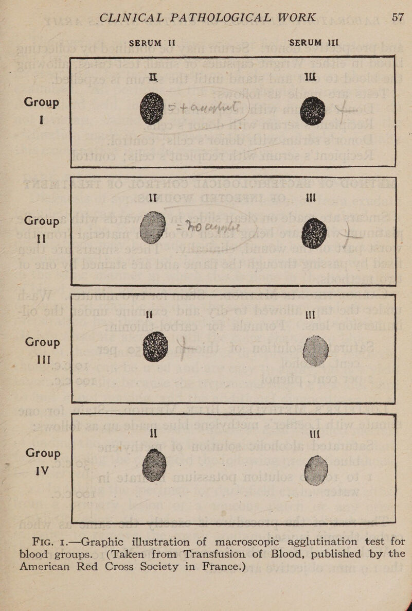  Group H Group Ill Group IV  Fic. 1.—Graphic illustration of macroscopic agglutination test for blood groups. (Taken from Transfusion of Blood, published by the American Red Cross Society in France.)