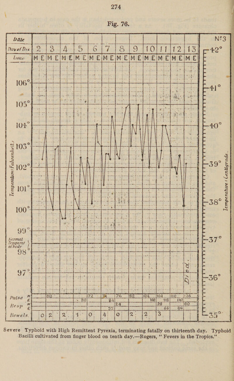 Fig. 76. Date | is] Ne a Povo pi 6 BAB ; i lime oe TE MEW EME nEMERERE     - 7 see ee 41°  iE tN &lt;e) ° Temperature ( Lentigrade., Temperalure( Fahrenheit. W 00 ° Normab &gt; 4. de ofeldee cents , aie ate a shin Ei ae ee eee Severe Typhoid with High Remittent Pyrexia, terminating fatally on thirteenth day. Typhoid Bacilli cultivated from finger blood on tenth day.—Rogers, ‘‘ Fevers in the Tropics.”