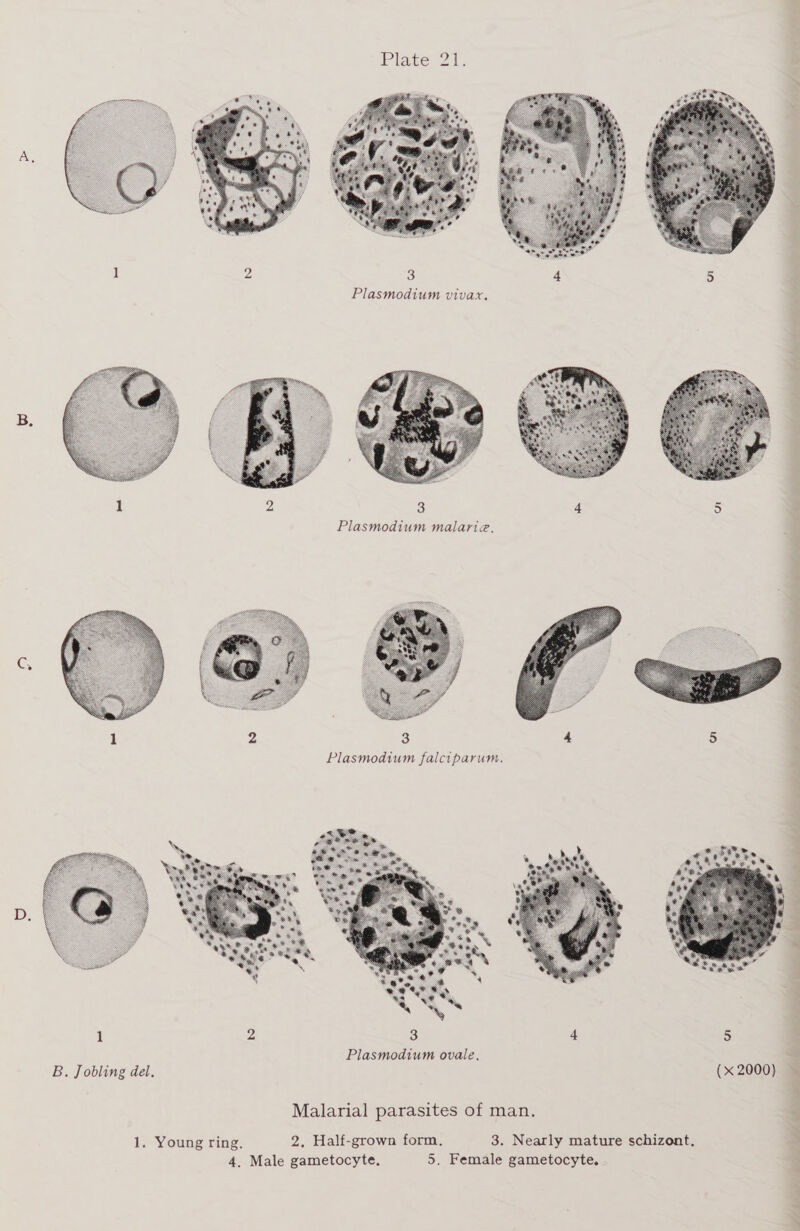  1 2 %} 4 5 Plasmodium malarie.  Plasmodium ovale, B. Jobling del, (x 2000) Malarial parasites of man. 1. Young ring. 2. Half-grown form. 3. Nearly mature schizont.