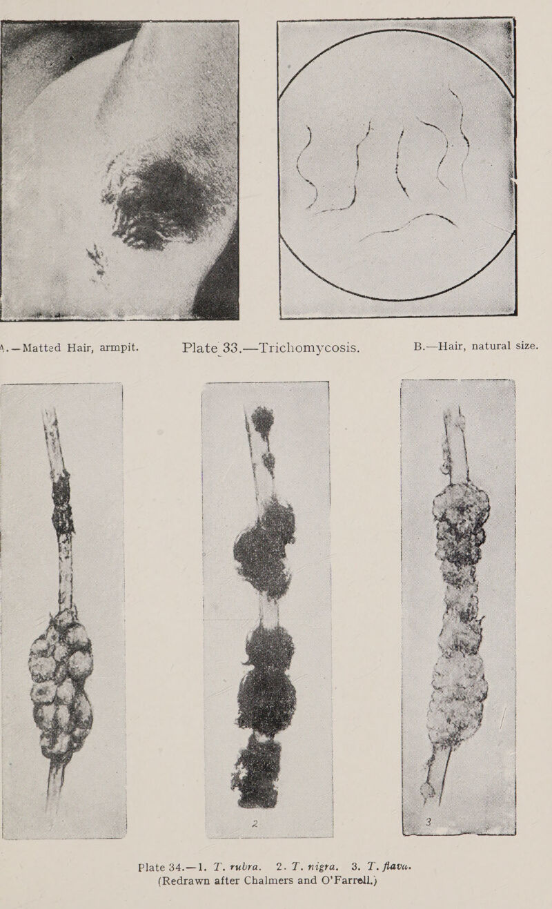  A,.—Matted Hair, armpit. Plate 33.—Trichomycosis. B.—Hair, natural size.    Plate 34.—1. T. rubra. 2.T.nigra. 3. T. flavu. (Redrawn after Chalmers and O’ Farrell.)