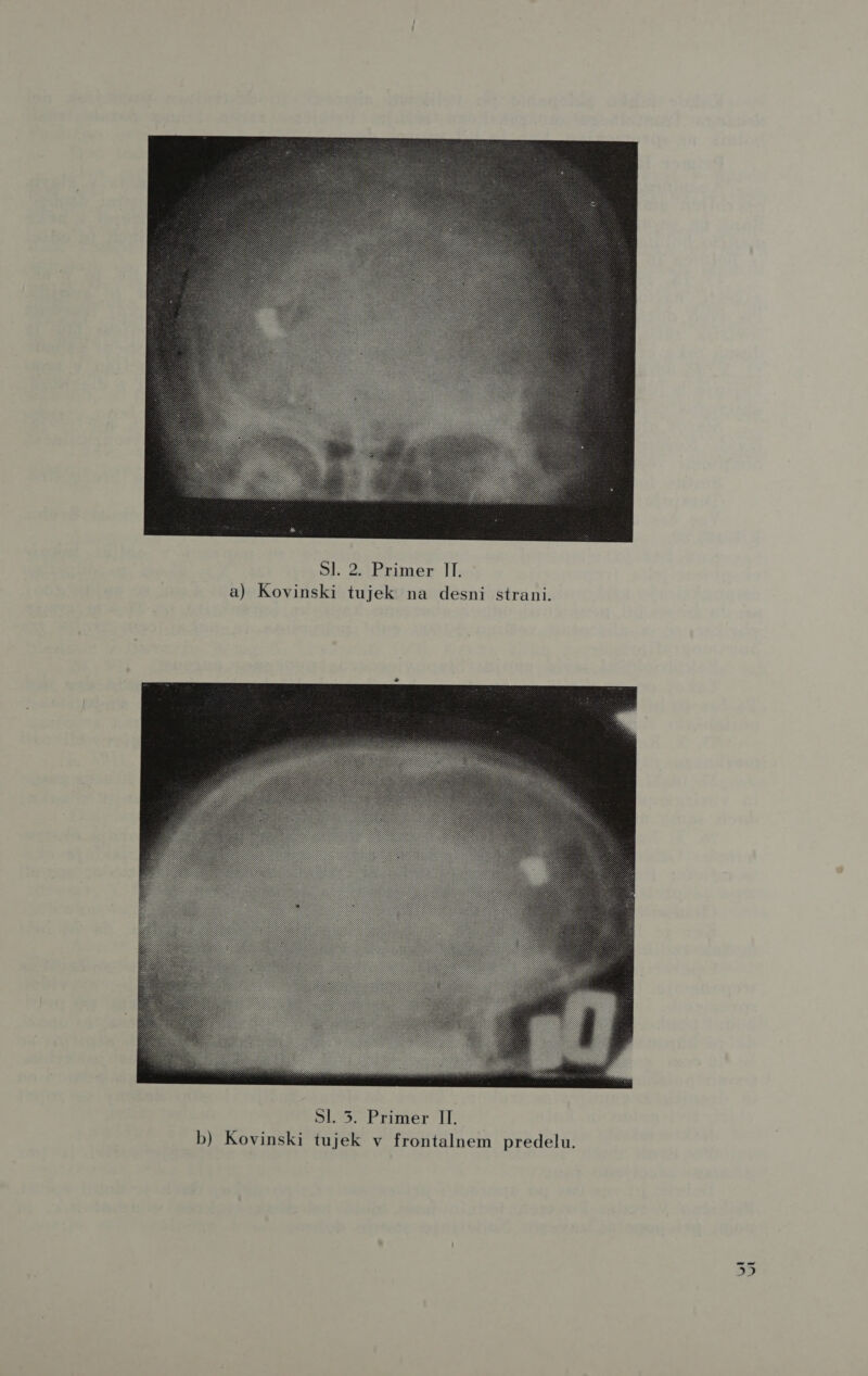  1 . Primer 2 S] a) Kovinsk l: i stran sn k na de je tu i  II k v frontalnem predelu . Primer 3 SI je tu b) Kovinski 1 ir