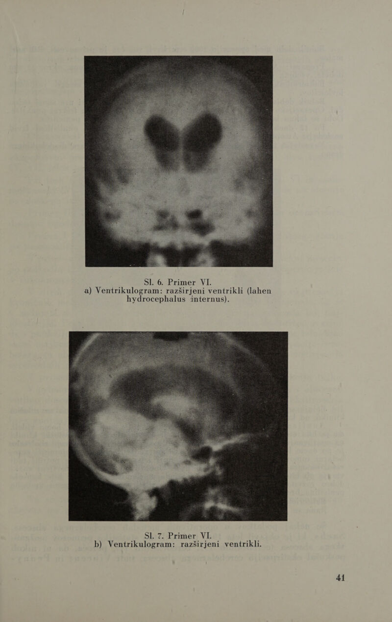  SI. 6. Primer VI. a) Ventrikulogram: razširjeni ventrikli (lahen hydrocephalus internus). 