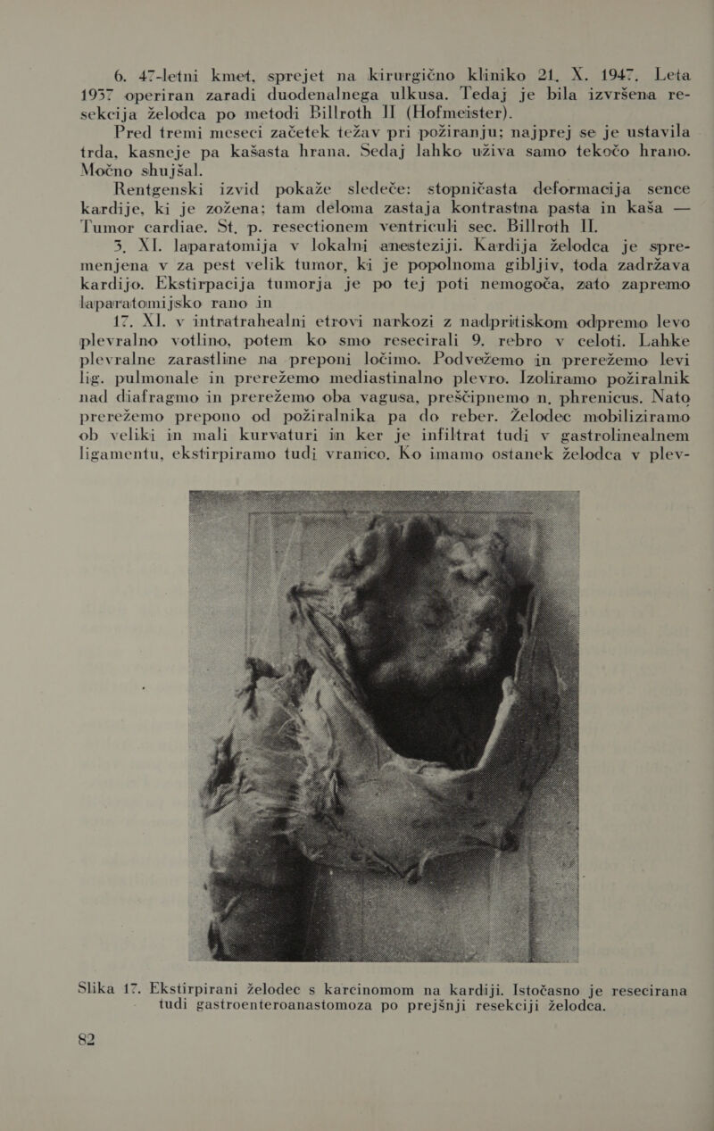 1957 operiran zaradi duodenalnega ulkusa. Tedaj je bila izvršena re- sekcija želodca po metodi Billroth II (Hofmeister). Pred tremi meseci začetek težav pri požiranju; najprej se je ustavila | trda, kasneje pa kašasta hrana. Sedaj lahko uživa samo tekočo hrano. Močno shujšal. Rentgenski izvid pokaže sledeče: stopničasta deformacija sence kardije. ki je zožena: tam deloma zastaja kontrastna pasta in kaša — Tumor cardiae. St. p. resectionem ventriculi sec. Billroth II. 3. XI. laparatomija v lokalni anesteziji. Kardija želodca je spre- menjena v za pest velik tumor, ki je popolnoma gibljiv, toda zadržava kardijo. Ekstirpacija tumorja je po tej poti nemogoča, zato zapremo laparatomijsko rano in 17. XI. v intratrahealni etrovi narkozi z nadpritiskom odpremo levo plevralno votlino, potem ko smo resecirali 9. rebro v celoti. Lahke plevralne zarastline na preponi ločimo. Podvežemo in prerežemo levi lig. pulmonale in prerežemo mediastinalno plevro. Izoliramo požiralnik nad diafragmo in prerežemo oba vagusa, preščipnemo n, phrenicus. Nato prerežemo prepono od požiralnika pa do reber. Želodec mobiliziramo ob veliki in mali kurvaturi in ker je infiltrat tudi v gastrolinealnem ligamentu, ekstirpiramo tudi vranico. Ko imamo ostanek želodca v plev-  Slika 17. Ekstirpirani želodec s karcinomom na kardiji. Istočasno je resecirana tudi gastroenteroanastomoza po prejšnji resekciji želodca.