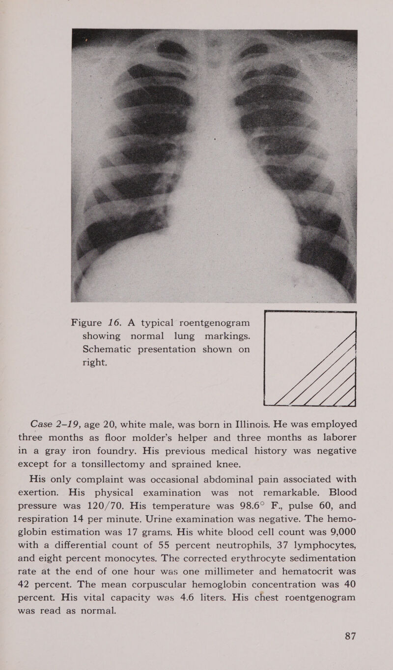  Figure 16. A typical roentgenogram showing normal lung markings. Schematic presentation shown on right.  Case 2-19, age 20, white male, was born in IIlinois. He was employed three months as floor molder’s helper and three months as laborer in a gray iron foundry. His previous medical history was negative except for a tonsillectomy and sprained knee. His only complaint was occasional abdominal pain associated with exertion. His physical examination was not remarkable. Blood pressure was 120/70. His temperature was 98.6° F., pulse 60, and respiration 14 per minute. Urine examination was negative. The hemo- globin estimation was 17 grams. His white blood cell count was 9,000 with a differential count of 55 percent neutrophils, 37 lymphocytes, and eight percent monocytes. The corrected erythrocyte sedimentation rate at the end of one hour was one millimeter and hematocrit was 42 percent. The mean corpuscular hemoglobin concentration was 40 percent. His vital capacity was 4.6 liters. His chest roentgenogram was read as normal.