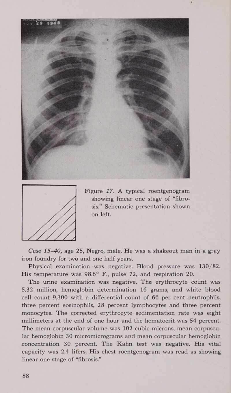  Figure 17. A typical roentgenogram showing linear one stage of “fibro- sis.” Schematic presentation shown on left.  Case 15-40, age 25, Negro, male. He was a shakeout man in a gray iron foundry for two and one half years. Physical examination was negative. Blood pressure was 130/82. His temperature was 98.6° F., pulse 72, and respiration 20. The urine examination was negative. The erythrocyte count was 5.32 million, hemoglobin determination 16 grams, and white blood cell count 9,300 with a differential count of 66 per cent neutrophils, three percent eosinophils, 28 percent lymphocytes and three percent monocytes. The corrected erythrocyte sedimentation rate was eight millimeters at the end of one hour and the hematocrit was 54 percent. The mean corpuscular volume was 102 cubic microns, mean corpuscu- lar hemoglobin 30 micromicrograms and mean corpuscular hemoglobin concentration 30 percent. The Kahn test was negative. His vital capacity was 2.4 liters. His chest roentgenogram was read as showing linear one stage of “fibrosis.”