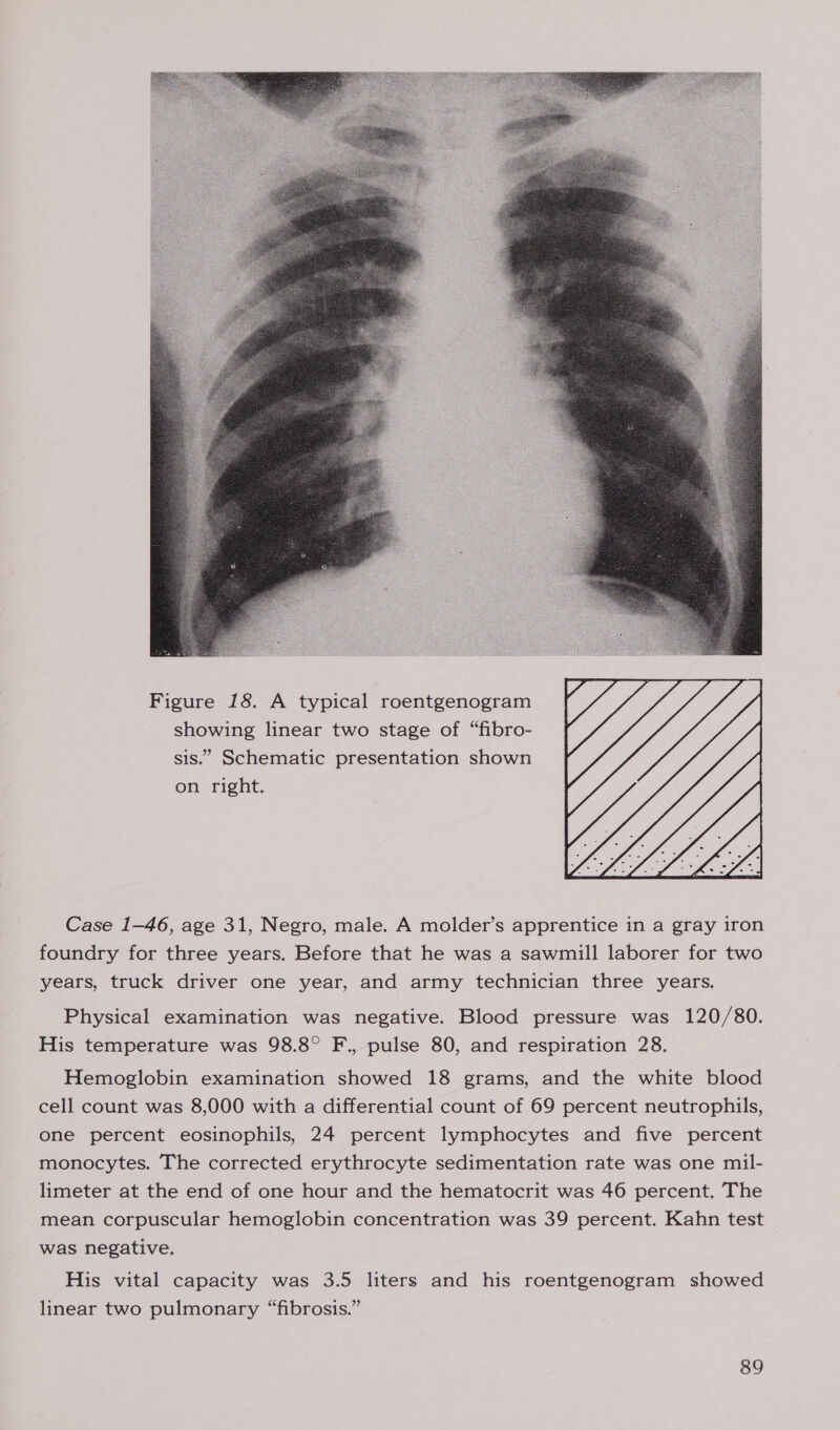  Figure 18. A typical roentgenogram showing linear two stage of “fibro- sis.” Schematic presentation shown on right.  Case 1-46, age 31, Negro, male. A molder’s apprentice in a gray iron foundry for three years. Before that he was a sawmill laborer for two years, truck driver one year, and army technician three years. Physical examination was negative. Blood pressure was 120/80. His temperature was 98.8° F., pulse 80, and respiration 28. Hemoglobin examination showed 18 grams, and the white blood cell count was 8,000 with a differential count of 69 percent neutrophils, one percent eosinophils, 24 percent lymphocytes and five percent monocytes. The corrected erythrocyte sedimentation rate was one mil- limeter at the end of one hour and the hematocrit was 46 percent. The mean corpuscular hemoglobin concentration was 39 percent. Kahn test was negative. His vital capacity was 3.5 liters and his roentgenogram showed linear two pulmonary “fibrosis.”