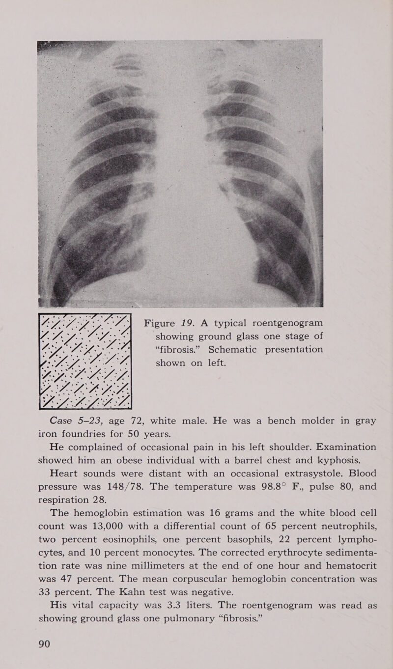  i GMO:  Yj Vy,   Figure 19. A typical roentgenogram showing ground glass one stage of “fibrosis.” Schematic presentation shown on left. Case 5-23, age 72, white male. He was a bench molder in gray iron foundries for 50 years. He complained of occasional pain in his left shoulder. Examination showed him an obese individual with a barrel chest and kyphosis. Heart sounds were distant with an occasional extrasystole. Blood pressure was 148/78. The temperature was 98.8° F., pulse 80, and respiration 28. The hemoglobin estimation was 16 grams and the white blood cell count was 13,000 with a differential count of 65 percent neutrophils, two percent eosinophils, one percent basophils, 22 percent lympho- cytes, and 10 percent monocytes. The corrected erythrocyte sedimenta- tion rate was nine millimeters at the end of one hour and hematocrit was 47 percent. The mean corpuscular hemoglobin concentration was 33 percent. The Kahn test was negative. His vital capacity was 3.3 liters. The roentgenogram was read as showing ground glass one pulmonary “fibrosis.”