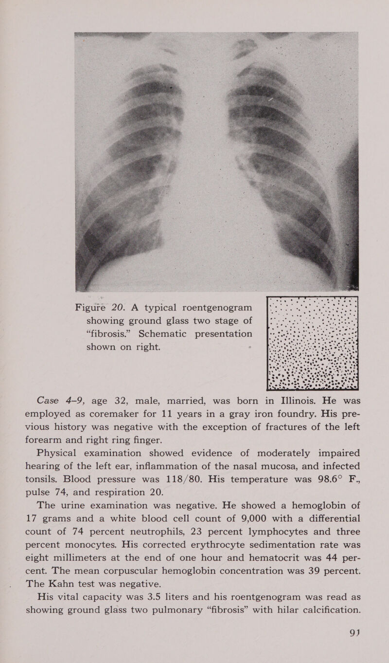   Case 4-9, age 32, male, married, was born in Illinois. He was employed as coremaker for 11 years in a gray iron foundry. His pre- vious history was negative with the exception of fractures of the left forearm and right ring finger. Physical examination showed evidence of moderately impaired hearing of the left ear, inflammation of the nasal mucosa, and infected tonsils. Blood pressure was 118/80. His temperature was 98.6° F., pulse 74, and respiration 20. The urine examination was negative. He showed a hemoglobin of 17 grams and a white blood cell count of 9,000 with a differential count of 74 percent neutrophils, 23 percent lymphocytes and three percent monocytes. His corrected erythrocyte sedimentation rate was eight millimeters at the end of one hour and hematocrit was 44 per- cent. The mean corpuscular hemoglobin concentration was 39 percent. The Kahn test was negative. His vital capacity was 3.5 liters and his roentgenogram was read as showing ground glass two pulmonary “fibrosis” with hilar calcification.