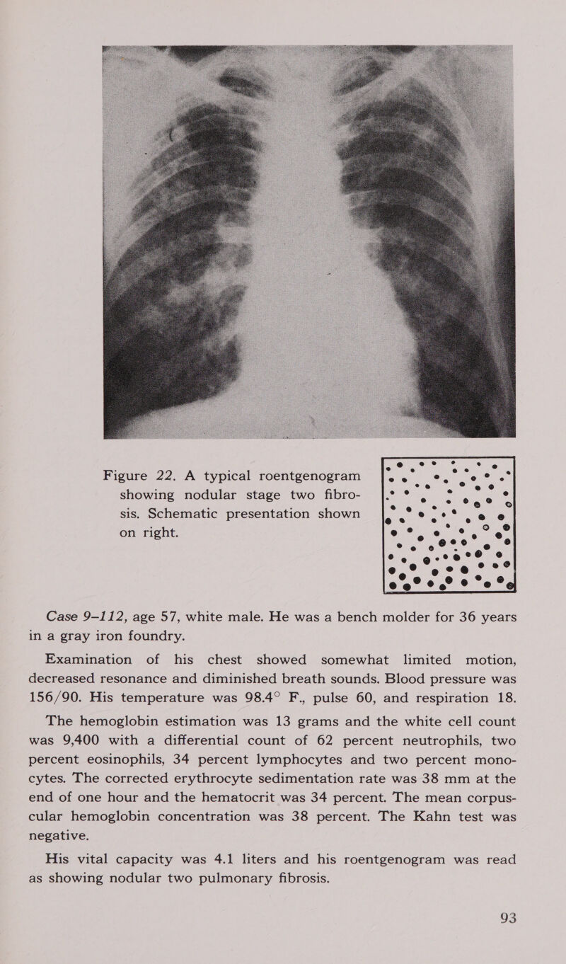  Figure 22. A typical roentgenogram showing nodular stage two fibro- sis. Schematic presentation shown on right.  Case 9-112, age 57, white male. He was a bench molder for 36 years in a gray iron foundry. Examination of his chest showed somewhat limited motion, decreased resonance and diminished breath sounds. Blood pressure was 156/90. His temperature was 98.4° F., pulse 60, and respiration 18. The hemoglobin estimation was 13 grams and the white cell count was 9,400 with a differential count of 62 percent neutrophils, two percent eosinophils, 34 percent lymphocytes and two percent mono- cytes. The corrected erythrocyte sedimentation rate was 38 mm at the end of one hour and the hematocrit was 34 percent. The mean corpus- cular hemoglobin concentration was 38 percent. The Kahn test was negative. His vital capacity was 4.1 liters and his roentgenogram was read as showing nodular two pulmonary fibrosis.