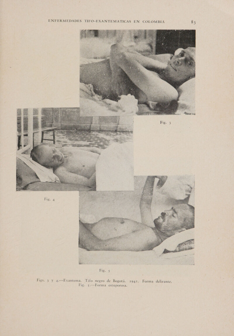  Figs. 3 y 4.—Exantema. Tifo negro de Bogotá. 1941. Forma delirante. Fig. 5.—Forma estuporosa.