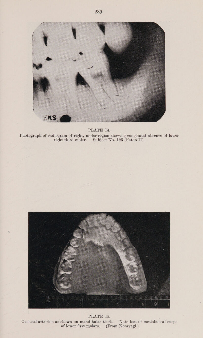  PLATE 14. Photograph of radiogram of right, molar region showing congenital absence of lower right third molar. Subject No. 125 (Patep II).  Occlusal attrition as shown on mandibular teeth. Note loss of mesiobuccal cusps of lower first molars. (From Koravagi.)