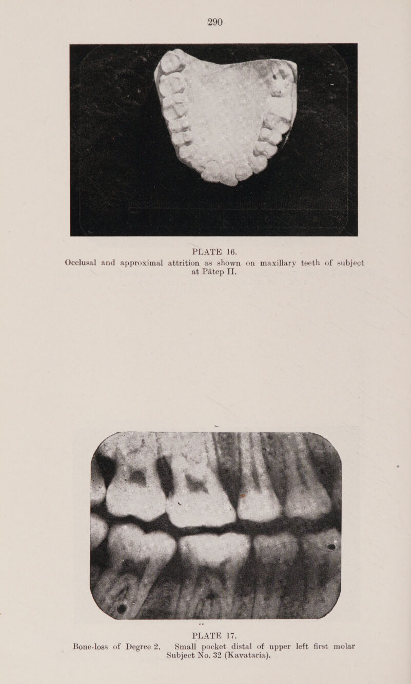   PLATE 16. Occlusal and approximal attrition as shown on maxillary teeth of at Patep IT. ubject   Bone-loss of Degree 2. Small pocket distal of upper left first molar