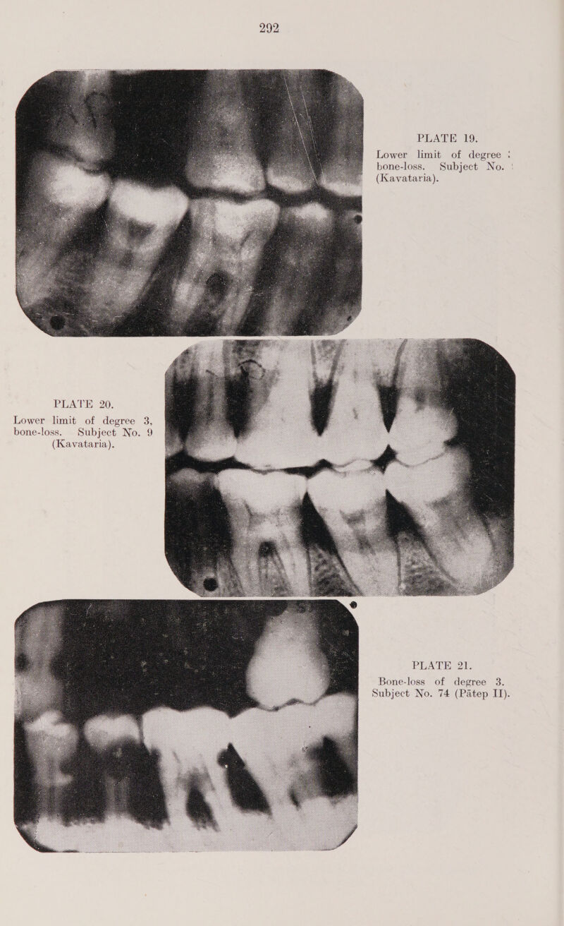 PLATE 19. Lower limit of degree : bone-loss. Subject No. | (Kavataria). PLATE 20. Lower limit of degree 3, bone-loss. Subject No. 9 (Kavataria). PLATE 21. Bone-loss of degree 3. Subject No. 74 (Patep II).