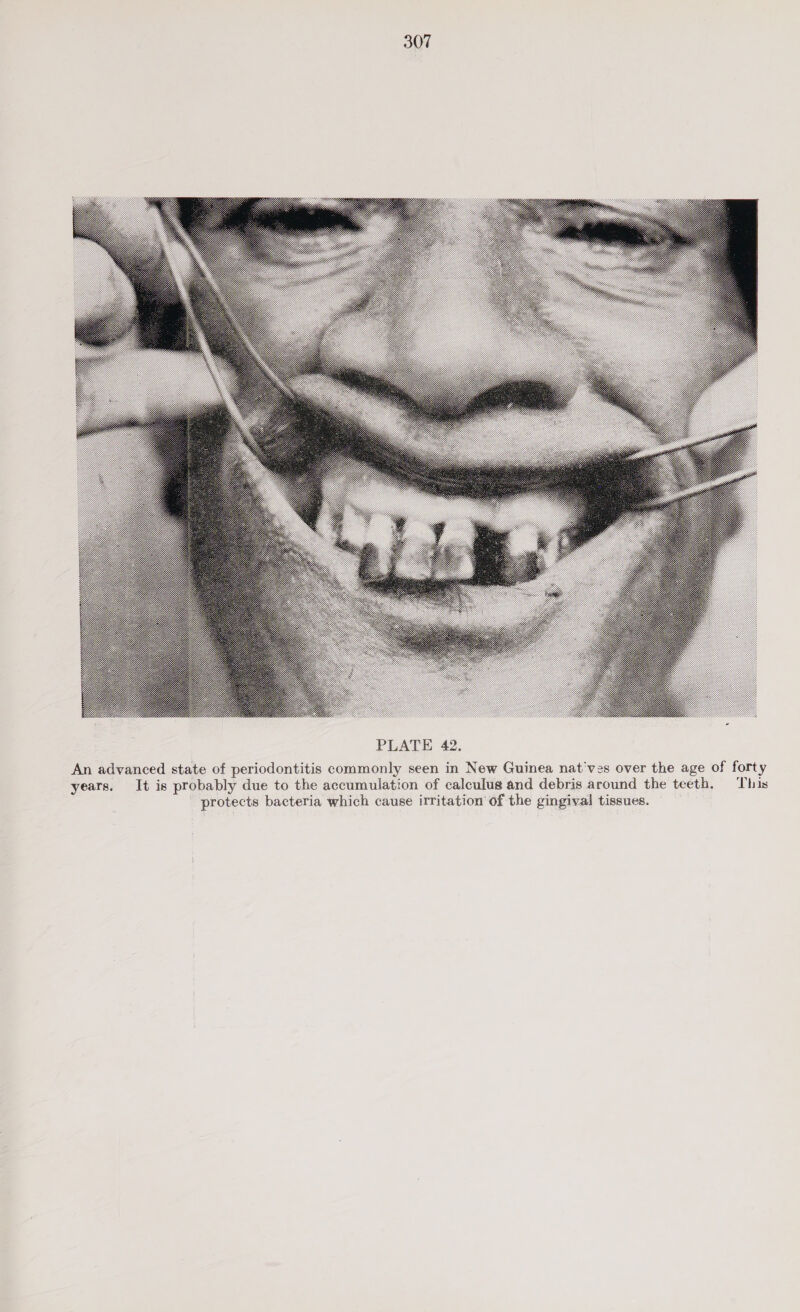  An advanced state of periodontitis commonly seen in New Guinea nat‘ves over the age of forty years. It is probably due to the accumulation of calculus and debris around the teeth. This protects bacteria which cause irritation of the gingival tissues.