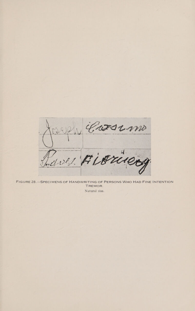  FIGURE 28.—SPECIMENS OF HANDWRITING OF PERSONS WHO HAD FINE INTENTION TREMOR. Natural size.