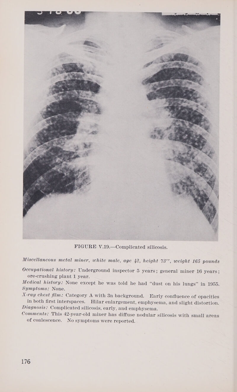  Miscellaneous metal miner, white male, age 42, height 73’’, weight 165 pounds Occupational history: Underground inspector 5 years; general miner 16 years; ore-crushing plant 1 year. Medical history: None except he was told he had “dust on his lungs” in 1955. Symptoms: None. X-ray chest film: Category A with 3n background. Early confluence of opacities in both first interspaces. Hilar enlargement, emphysema, and slight distortion. Diagnosis: Complicated silicosis, early, and emphysema. Comments: This 42-year-old miner has diffuse nodular silicosis with small areas of coalescence. No symptoms were reported.