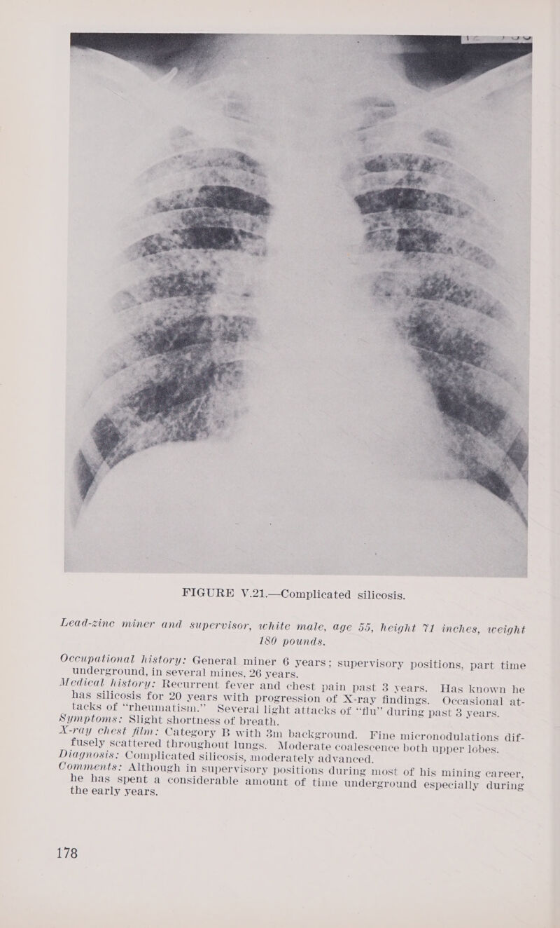  Lead-zine miner and supervisor, white male, age 55, height 71 inches, weight 180 pounds. Occupational history: General miner 6 years; supervisory positions, part time underground, in several mines, 26 years. Medical history: Recurrent fever and chest pain past 3 years. Has known he has silicosis for 20 years with progression of X-ray findings. Occasional at- tacks of “rheumatism.” Several light attacks of “flu” during past 3 years. Symptoms: Slight shortness of breath. X-ray chest film: Category B with 3m background. Fine micronodulations dif- fusely scattered throughout lungs. Moderate coalescence both upper lobes. Diagnosis: Complicated Silicosis, moderately advanced. Comments: Although in supervisory positions during most of his mining career, he has spent a considerable amount of time underground especially during the early years.