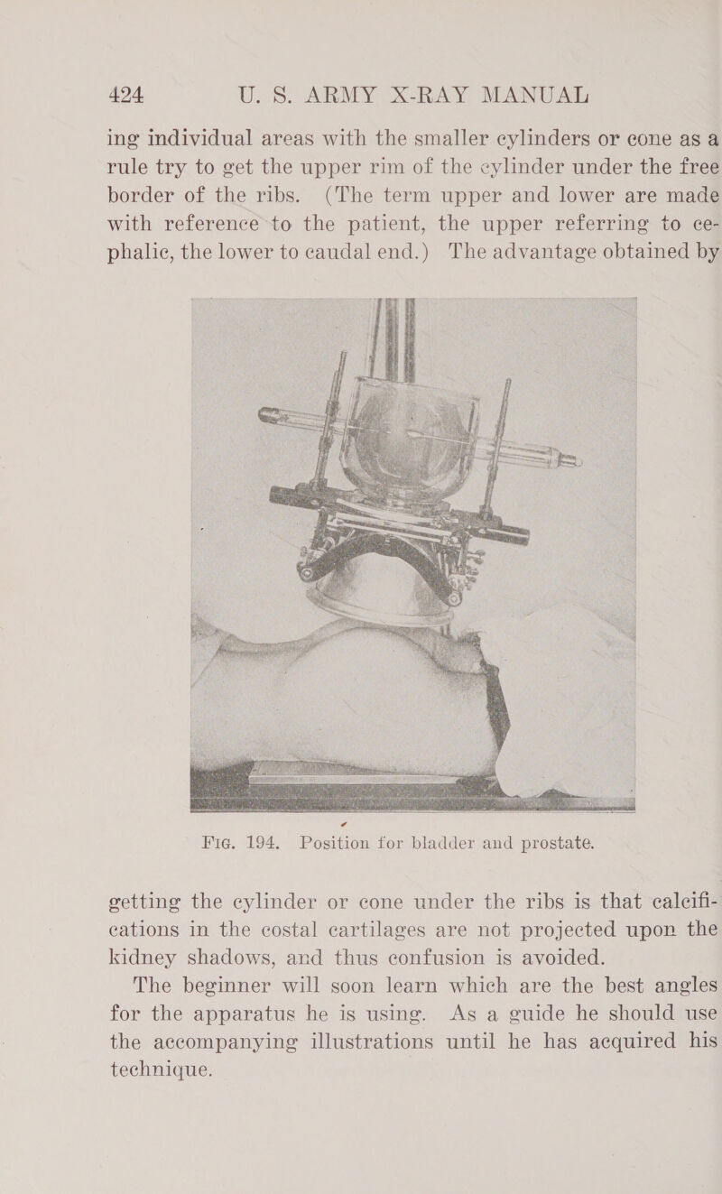 ing individual areas with the smaller cylinders or cone as a rule try to get the upper rim of the cylinder under the free border of the ribs. (The term upper and lower are made with reference to the patient, the upper referring to ce- phalic, the lower to caudal end.) The advantage obtained by  getting the cylinder or cone under the ribs is that calecifi- cations in the costal cartilages are not projected upon the kidney shadows, and thus confusion is avoided. The beginner will soon learn which are the best angles for the apparatus he is using. Ags a guide he should use the accompanying illustrations until he has acquired his technique.