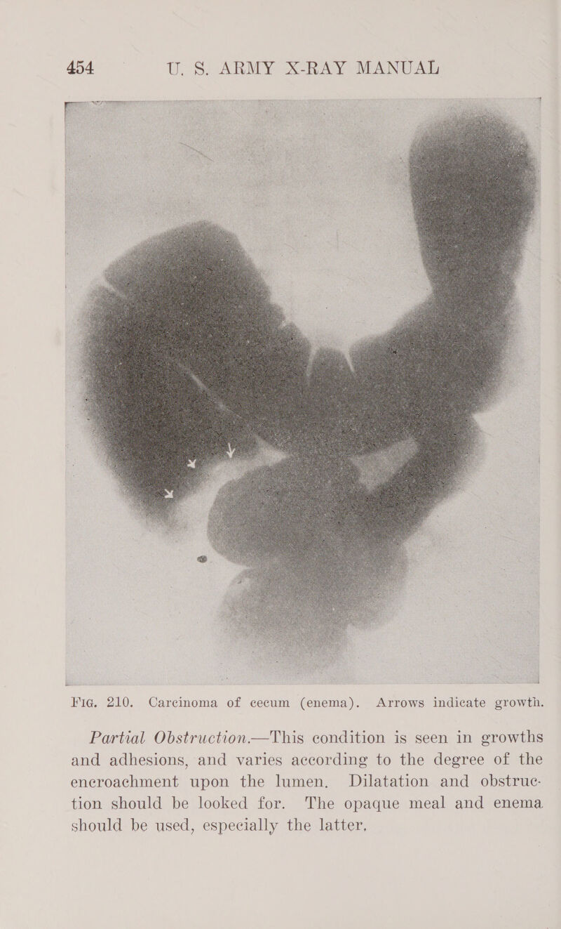  Fig. 210. Carcinoma of cecum (enema). Arrows indicate growth. Partial Obstruction—This condition is seen in growths and adhesions, and varies according to the degree of the encroachment upon the lumen, Dilatation and obstruc- tion should be looked for. The opaque meal and enema should be used, especially the latter,