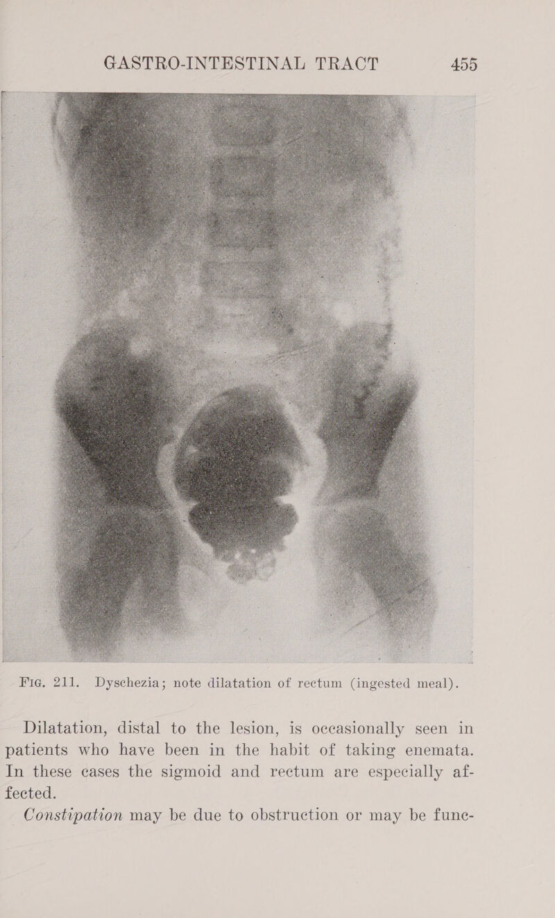  Fie. 211. Dyschezia; note dilatation of rectum (ingested meal). Dilatation, distal to the lesion, is occasionally seen in patients who have been in the habit of taking enemata. In these cases the sigmoid and rectum are especially af- fected. Constipation may be due to obstruction or may be fune-