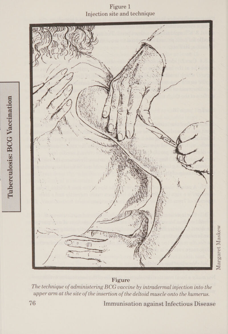 Figure 1 Injection site and technique -~  Figure The technique of administering BCG vaccine by intradermal injection into the upper arm at the site of the insertion of the deltoid muscle onto the humerus. Margaret Maskew