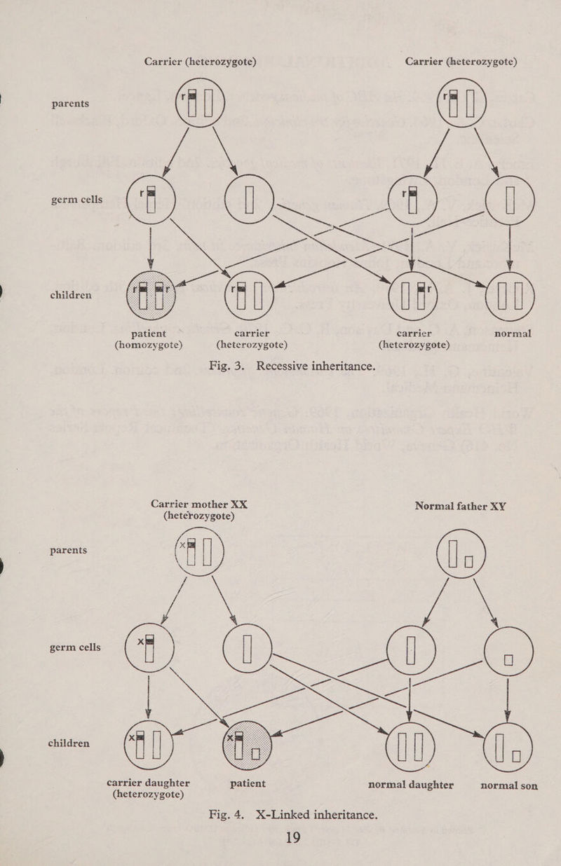 Carrier (heterozygote) Carrier (heterozygote) parents (40)    germ cells children patient — carrier carrier normal (homozygote) (heterozygote) (heterozygote) Fig. 3. Recessive inheritance. Carrier mother XX Normal father XY (heterozygote) parents germ cells children carrier daughter patient normal daughter normal son (heterozygote)