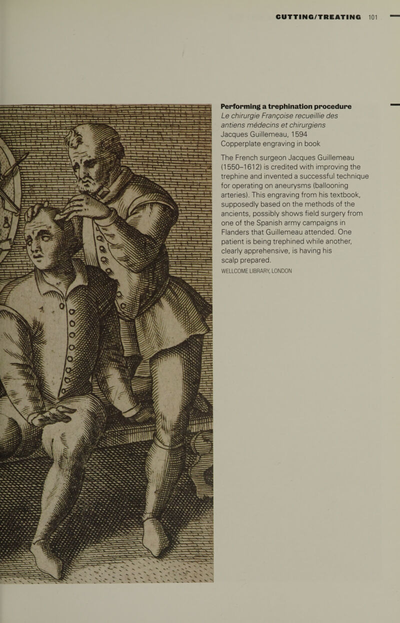 Performing a trephination procedure Le chirurgie Frangoise recueillie des antiens medecins et chirurgiens Jacques Guillemeau, 1594 Copperplate engraving in book The French surgeon Jacques Guillemeau (1550-1612) is credited with improving the trephine and invented a successful technique for operating on aneurysms (ballooning arteries). This engraving from his textbook, supposedly based on the methods of the ancients, possibly shows field surgery from one of the Spanish army campaigns in Flanders that Guillemeau attended. One patient is being trephined while another, clearly apprehensive, is having his scalp prepared. WELLCOME LIBRARY, LONDON