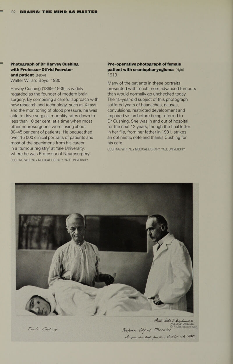 Photograph of Dr Harvey Cushing with Professor Otfrid Foerster and patient (below) Walter Willard Boyd, 1930 Harvey Cushing (1869-1939) is widely regarded as the founder of modern brain surgery. By combining a careful approach with new research and technology, such as X-rays and the monitoring of blood pressure, he was able to drive surgical mortality rates down to less than 10 per cent, at a time when most other neurosurgeons were losing about 30-45 per cent of patients. He bequeathed over 15 000 clinical portraits of patients and most of the specimens from his career in a 'tumour registry' at Yale University, where he was Professor of Neurosurgery. CUSHING/WHITNEY MEDICAL LIBRARY, YALE UNIVERSITY Pre-operative photograph of female patient with craniopharyngioma (right) 1919 Many of the patients in these portraits presented with much more advanced tumours than would normally go unchecked today. The 15-year-old subject of this photograph suffered years of headaches, nausea, convulsions, restricted development and impaired vision before being referred to Dr Cushing. She was in and out of hospital for the next 12 years, though the final letter in her file, from her father in 1931, strikes an optimistic note and thanks Cushing for his care. CUSHING/WHITNEY MEDICAL LIBRARY, YALE UNIVERSITY J&oe-Jor- WasX/ yW.-D. n /? M. ra^s-JSr. © WALTER WILLARD BOYD. Professor Offr/rl *5itrfeo/? -rr> ■ cA/of. fro ■/pm. cfTir At/es/- /A f&SG.