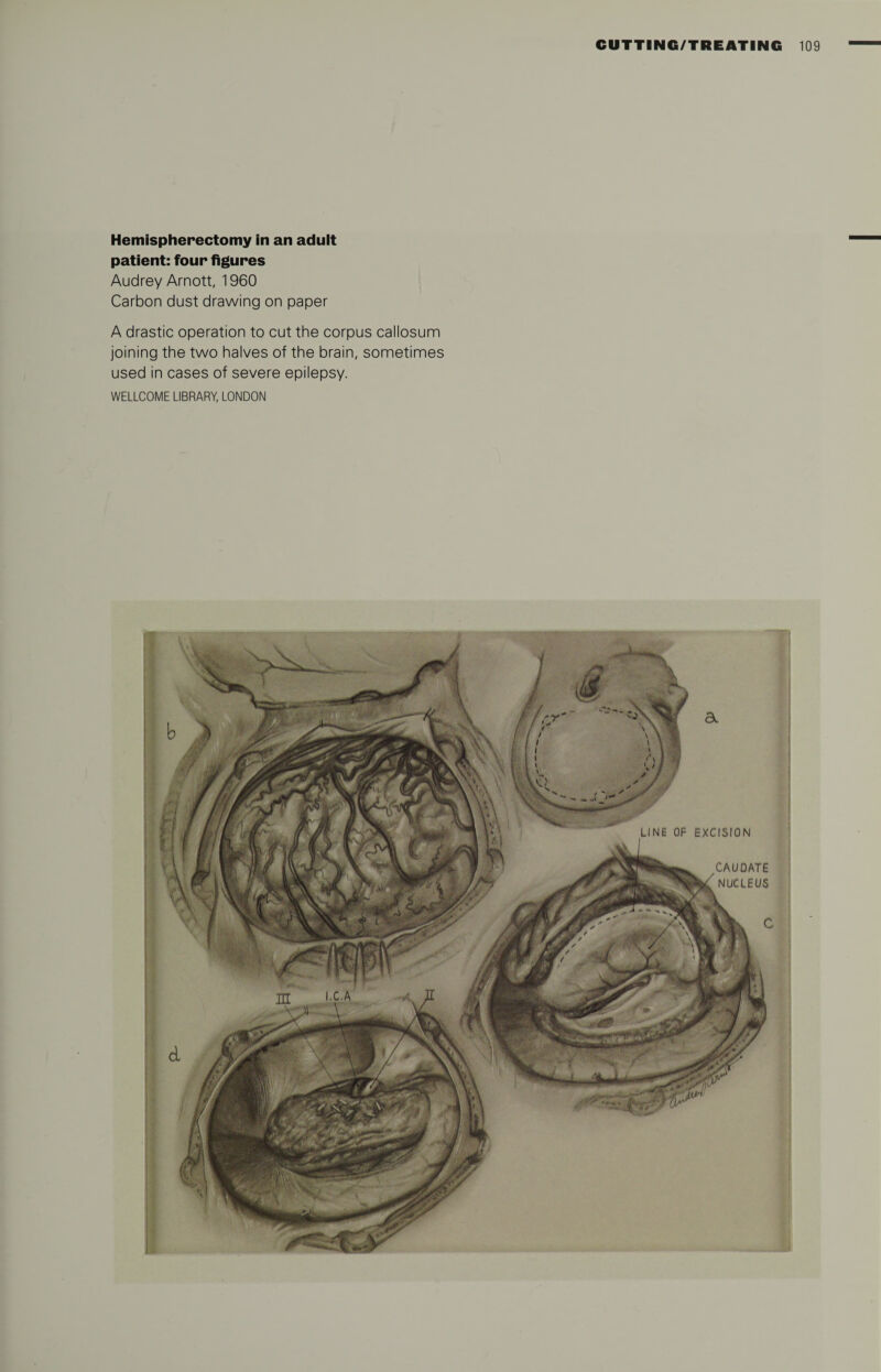 Hemispherectomy in an adult patient: four figures Audrey Arnott, 1960 Carbon dust drawing on paper A drastic operation to cut the corpus callosum joining the two halves of the brain, sometimes used in cases of severe epilepsy. WELLCOME LIBRARY, LONDON