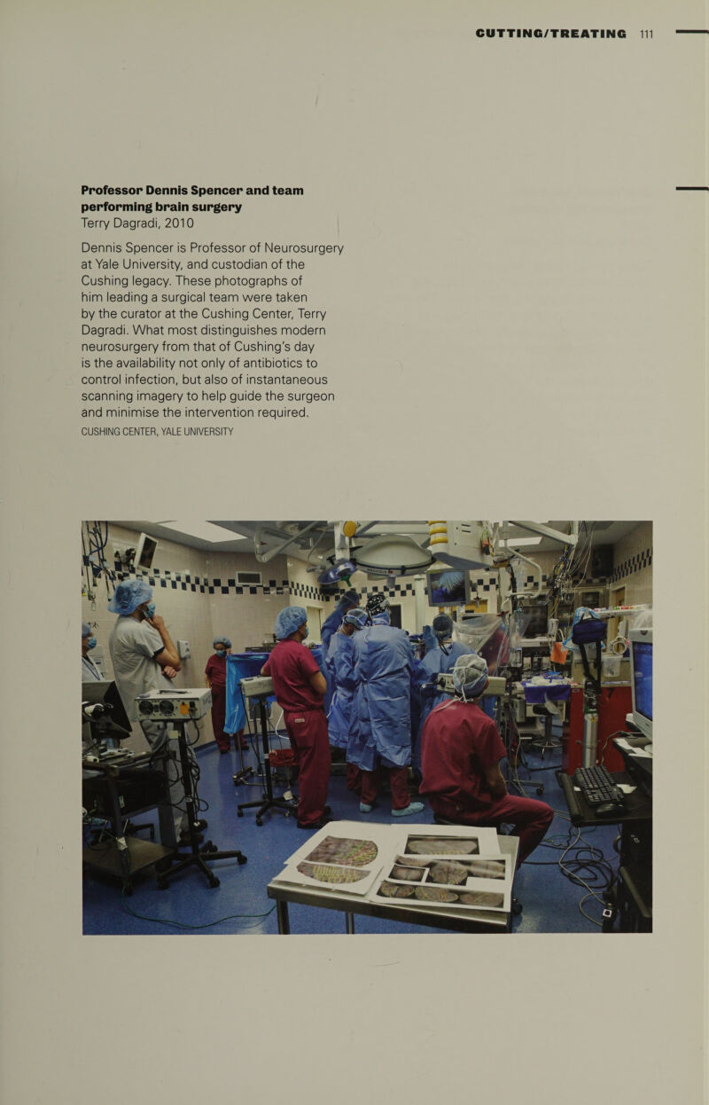 Professor Dennis Spencer and team performing brain surgery Terry Dagradi, 2010 Dennis Spencer is Professor of Neurosurgery at Yale University, and custodian of the Cushing legacy. These photographs of him leading a surgical team were taken by the curator at the Cushing Center, Terry Dagradi. What most distinguishes modern neurosurgery from that of Cushing's day is the availability not only of antibiotics to control infection, but also of instantaneous scanning imagery to help guide the surgeon and minimise the intervention required. CUSHING CENTER, YALE UNIVERSITY ET t ‘Zv.