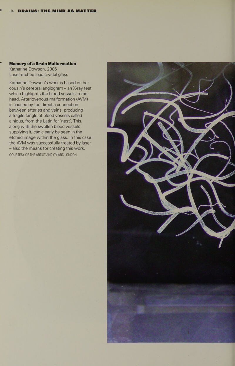 Memory of a Brain Malformation Katharine Dowson, 2006 Laser-etched lead crystal glass Katharine Dowson's work is based on her cousin's cerebral angiogram - an X-ray test which highlights the blood vessels in the head. Arteriovenous malformation (AVM) is caused by too direct a connection between arteries and veins, producing a fragile tangle of blood vessels called a nidus, from the Latin for 'nest'. This, along with the swollen blood vessels supplying it, can clearly be seen in the etched image within the glass. In this case the AVM was successfully treated by laser - also the means for creating this work.