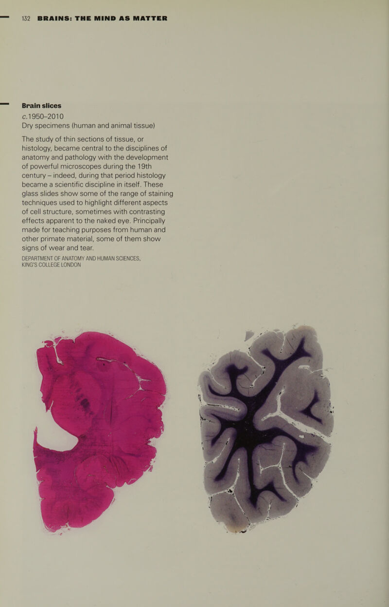 Brain slices c. 1950-2010 Dry specimens (human and animal tissue) The study of thin sections of tissue, or histology, became central to the disciplines of anatomy and pathology with the development of powerful microscopes during the 19th century - indeed, during that period histology became a scientific discipline in itself. These glass slides show some of the range of staining techniques used to highlight different aspects of cell structure, sometimes with contrasting effects apparent to the naked eye. Principally made for teaching purposes from human and other primate material, some of them show signs of wear and tear. DEPARTMENT OF ANATOMY AND HUMAN SCIENCES, KING’S COLLEGE LONDON