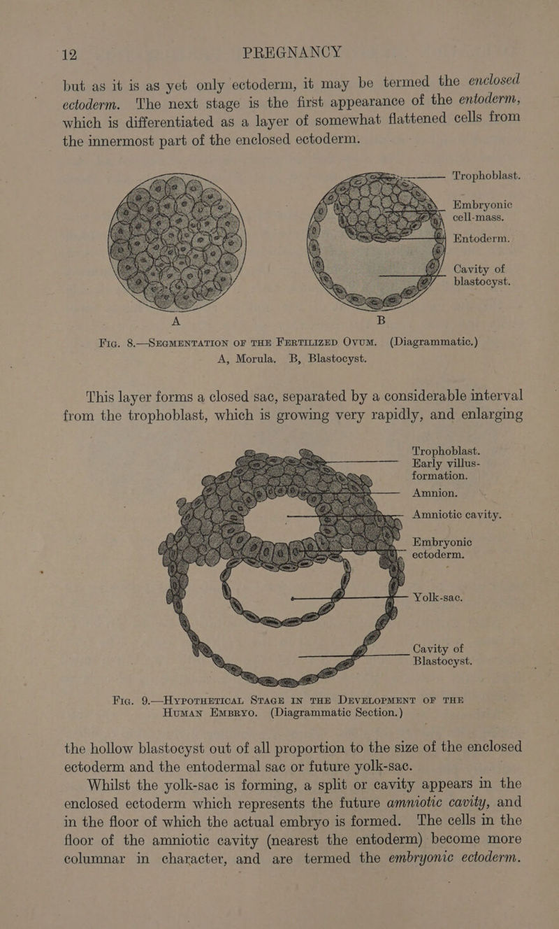 but as it is as yet only ectoderm, it may be termed the enclosed ectoderm. The next stage is the first appearance of the entoderm, which ig differentiated as a layer of somewhat flattened cells from the innermost part of the enclosed ectoderm. 2&lt;&lt;-————_ Trophoblast. Embryonic cell-mass. Entoderm. Cavity of blastocyst. Fig. 8.—SEGMENTATION OF THE FERTILIZED Ovum. (Diagrammatic.) A, Morula. B, Blastocyst. This layer forms a closed sac, separated by a considerable interval from the trophoblast, which is growing very rapidly, and enlarging Trophoblast. Early villus- formation. Amnion. Amniotic cavity. Embryonic ectoderm. Yolk-sac. Cavity of Blastocyst. Fiq. 9.—HyporTHETICAL STAGE IN THE DEVELOPMENT OF THE Human Empryo. (Diagrammatic Section.) the hollow blastocyst out of all proportion to the size of the enclosed ectoderm and the entodermal sac or future yolk-sac. 34 Whilst the yolk-sac is forming, a split or cavity appears in the enclosed ectoderm which represents the future ammiotic cavity, and in the floor of which the actual embryo is formed. The cells in the floor of the amniotic cavity (nearest the entoderm) become more columnar in character, and are termed the embryonic ectoderm.