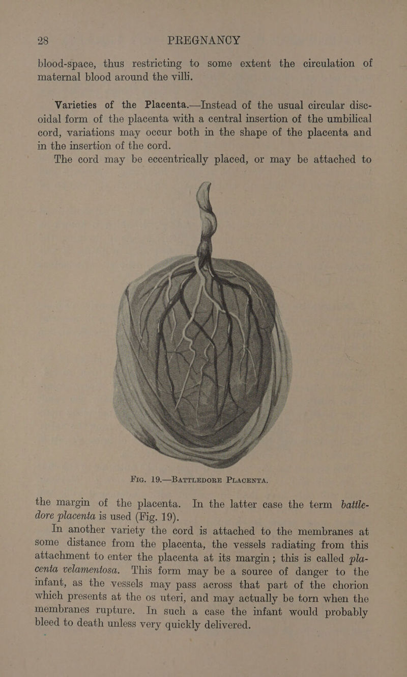 blood-space, thus restrictmg to some extent the circulation of maternal blood around the villi. Varieties of the Placenta.—Instead of the usual circular disc- oidal form of the placenta with a central msertion of the umbilical cord, variations may occur both in the shape of the placenta and in the insertion of the cord. The cord may be eccentrically placed, or may be attached to the margin of the placenta. In the latter case the term battle- dore placenta is used (Fig. 19). : In another variety the cord is attached to the membranes at some distance from the placenta, the vessels radiating from this attachment to enter the placenta at its margin; this is called pla- centa velamentosa. This form may be a source of danger to the infant, as the vessels may pass across that part of the chorion which presents at the os uteri, and may actually be torn when the membranes rupture. In such a case the infant would probably bleed to death unless very quickly delivered.