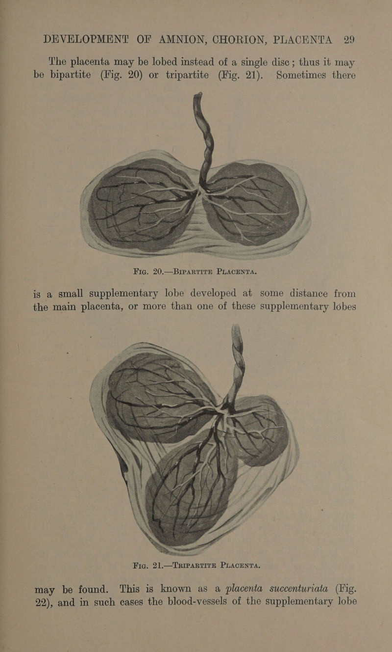 The placenta may be lobed instead of a single disc ; thus 1t may be bipartite (Hig. 20) or tripartite (Fig. 21). Sometimes there Fig. 20.—BIPARTITE PLACENTA. is a small supplementary lobe developed at some distance from the main placenta, or more than one of these supplementary lobes may be found. This is known as a placenta succenturiata (Fig. 92), and in such cases the blood-vessels of the supplementary lobe