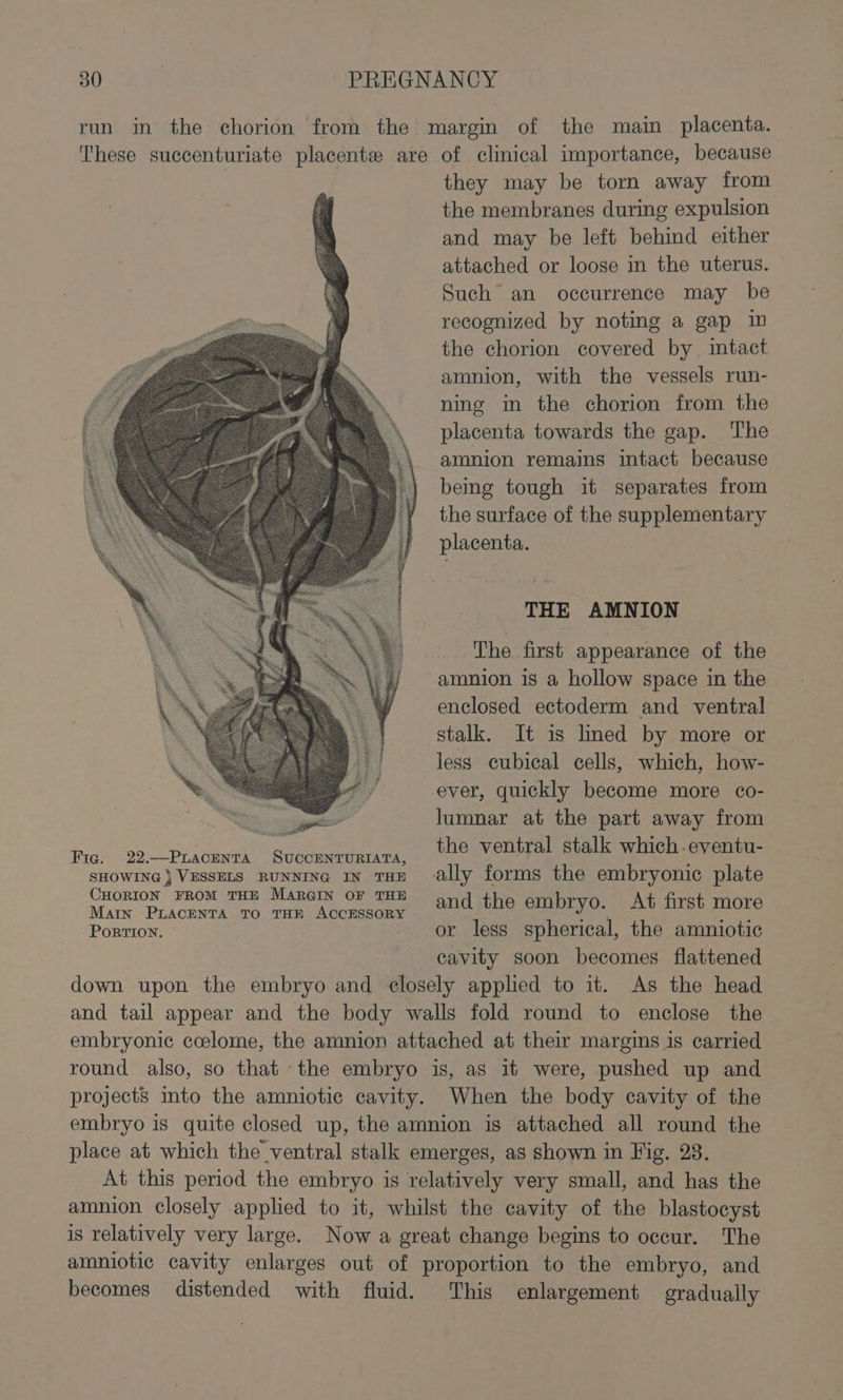 ran in the chorion from the margin of the main placenta. These succenturiate placente are of clinical importance, because they may be torn away from { the membranes during expulsion . and may be left behind either attached or loose in the uterus. Such an occurrence may be recognized by noting a gap in the chorion covered by. intact amnion, with the vessels run- ning in the chorion from the placenta towards the gap. The amnion remains intact because bemg tough it separates from the surface of the supplementary placenta. THE AMNION The first appearance of the amnion is a hollow space in the enclosed ectoderm and ventral stalk. It is lined by more or less cubical cells, which, how- ever, quickly become more co- lumnar at the part away from Fic. 22.—PiLacenta SUCCENTURIATA, the ventral stalk which eventu- SHOWING } VESSELS RUNNING IN THE lly forms the embryonic plate CHORION FROM THE MARGIN OF THE and the embryo. At first more Main PLACENTA TO THE ACCESSORY , PoRTION. - or less spherical, the amniotic cavity soon becomes flattened down upon the embryo and closely applied to it. As the head and tail appear and the body walls fold round to enclose the embryonic ccelome, the amnion attached at their margins is carried round also, so that the embryo is, as it were, pushed up and projects mto the amniotic cavity. When the body cavity of the embryo is quite closed up, the amnion is attached all round the place at which the ventral stalk emerges, as shown in Fig. 23. At this period the embryo is relatively very small, and has the amnion closely applied to it, whilst the cavity of the blastocyst is relatively very large. Now a great change begins to occur. The amniotic cavity enlarges out of proportion to the embryo, and becomes distended with fluid. This enlargement gradually