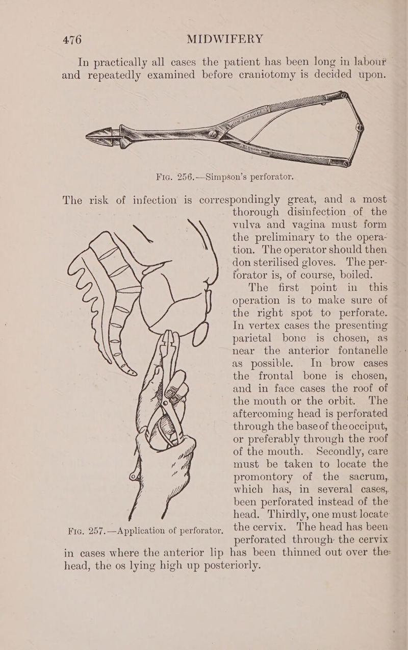 Fic. 257.—Application of perforator. thorough disinfection of the vulva and vagina must form the preliminary to the opera- tion. The operator should then don sterilised gloves. The per- forator is, of course, boiled. The first point in this operation is to make sure of the right spot to perforate. In vertex cases the presenting parietal bone is chosen, as near the anterior fontanelle as possible. In brow cases the frontal bone is chosen, and in face cases the roof of the mouth or the orbit. The aftercoming head is perforated through the base of the occiput, or preferably through the roof of the mouth. Secondly, care must be taken to locate the promontory of the sacrum, which has, in several cases,. been perforated instead of the head. Thirdly, one must locate the cervix. The head has been perforated through the cervix