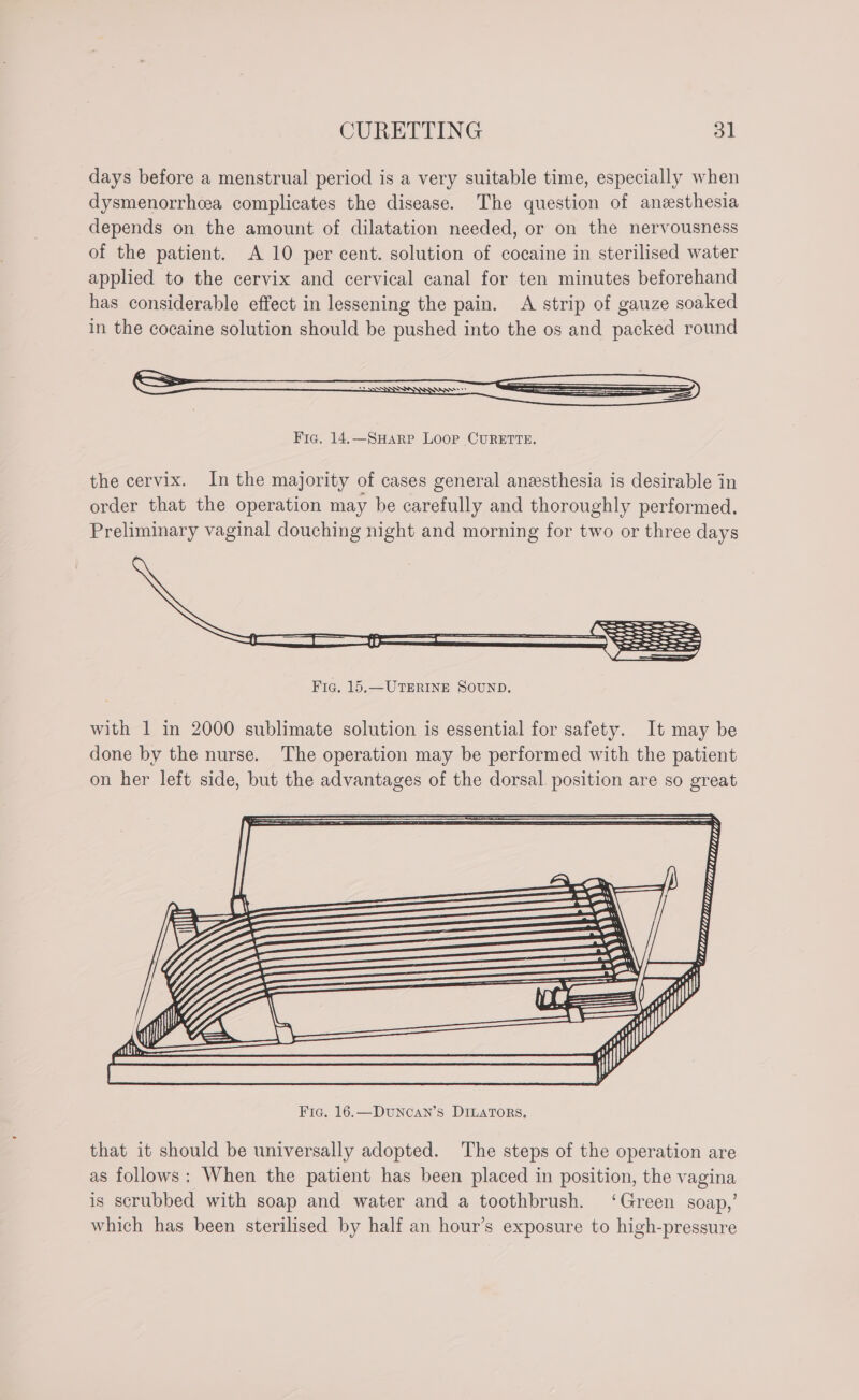 days before a menstrual period is a very suitable time, especially when dysmenorrhcea complicates the disease. The question of anzsthesia depends on the amount of dilatation needed, or on the nervousness of the patient. A 10 per cent. solution of cocaine in sterilised water applied to the cervix and cervical canal for ten minutes beforehand has considerable effect in lessening the pain. A strip of gauze soaked in the cocaine solution should be pushed into the os and packed round Fig. 14.—SHaRP Loop CURETTE. the cervix. In the majority of cases general anesthesia is desirable in order that the operation may be carefully and thoroughly performed. Preliminary vaginal douching night and morning for two or three days Fic. 15.—UTERINE SOUND. with 1 in 2000 sublimate solution is essential for safety. It may be done by the nurse. The operation may be performed with the patient on her left side, but the advantages of the dorsal. position are so great that it should be universally adopted. The steps of the operation are as follows: When the patient has been placed in position, the vagina is scrubbed with soap and water and a toothbrush. ‘Green soap,’ which has been sterilised by half an hour’s exposure to high-pressure