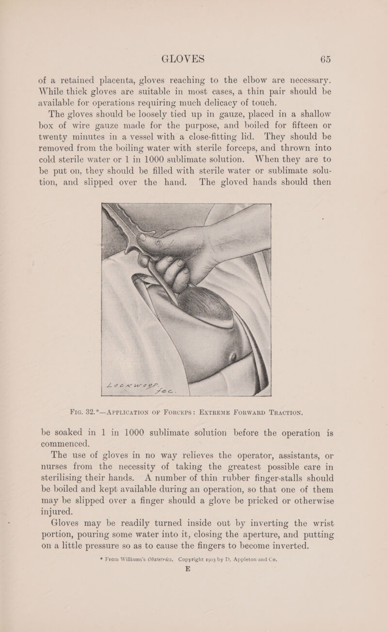 of a retained placenta, gloves reaching to the elbow are necessary. While thick gloves are suitable in most cases, a thin pair should be available for operations requiring much delicacy of touch. The gloves should be loosely tied up in gauze, placed in a shallow box of wire gauze made for the purpose, and boiled for fifteen or twenty minutes in a vessel with a close-fitting lid. They should be removed from the boiling water with sterile forceps, and thrown into cold sterile water or 1 in 1000 sublimate solution. When they are to be put on, they should be filled with sterile water or sublimate solu- tion, and slipped over the hand. The gloved hands should then | | | | | Agen wee, oo Ey me Fig. 32.*—APPLICATION OF ForcePS: EXTREME FORWARD TRACTION. be soaked in 1 in 1000 sublimate solution before the operation is commenced. The use of gloves in no way relieves the operator, assistants, or nurses from the necessity of taking the greatest possible care in sterilising their hands. A number of thin rubber finger-stalls should be boiled and kept available during an operation, so that one of them may be slipped over a finger should a glove be pricked or otherwise injured. Gloves may be readily turned inside out by inverting the wrist portion, pouring some water into it, closing the aperture, and putting on a little pressure so as to cause the fingers to become inverted. * From Williams’s Obstetrics. Copyright 1903 by D. Appleton and Co. E