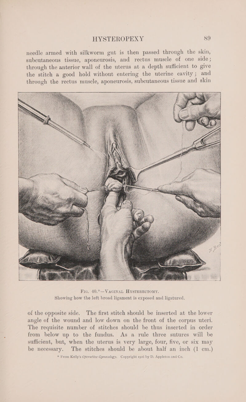 Fic, 40.*—VaGiInAi HYSTERECTOMY. Showing how the left broad ligament is exposed and ligatured. ot the opposite side. The first stitch should be inserted at the lower angle of the wound and low down on the front of the corpus uteri. The requisite number of stitches should be thus inserted in order from below up to the fundus. As a rule three sutures will be sufficient, but, when the uterus is very large, four, five, or six may be necessary. The stitches should be about half an inch (1 cm.)