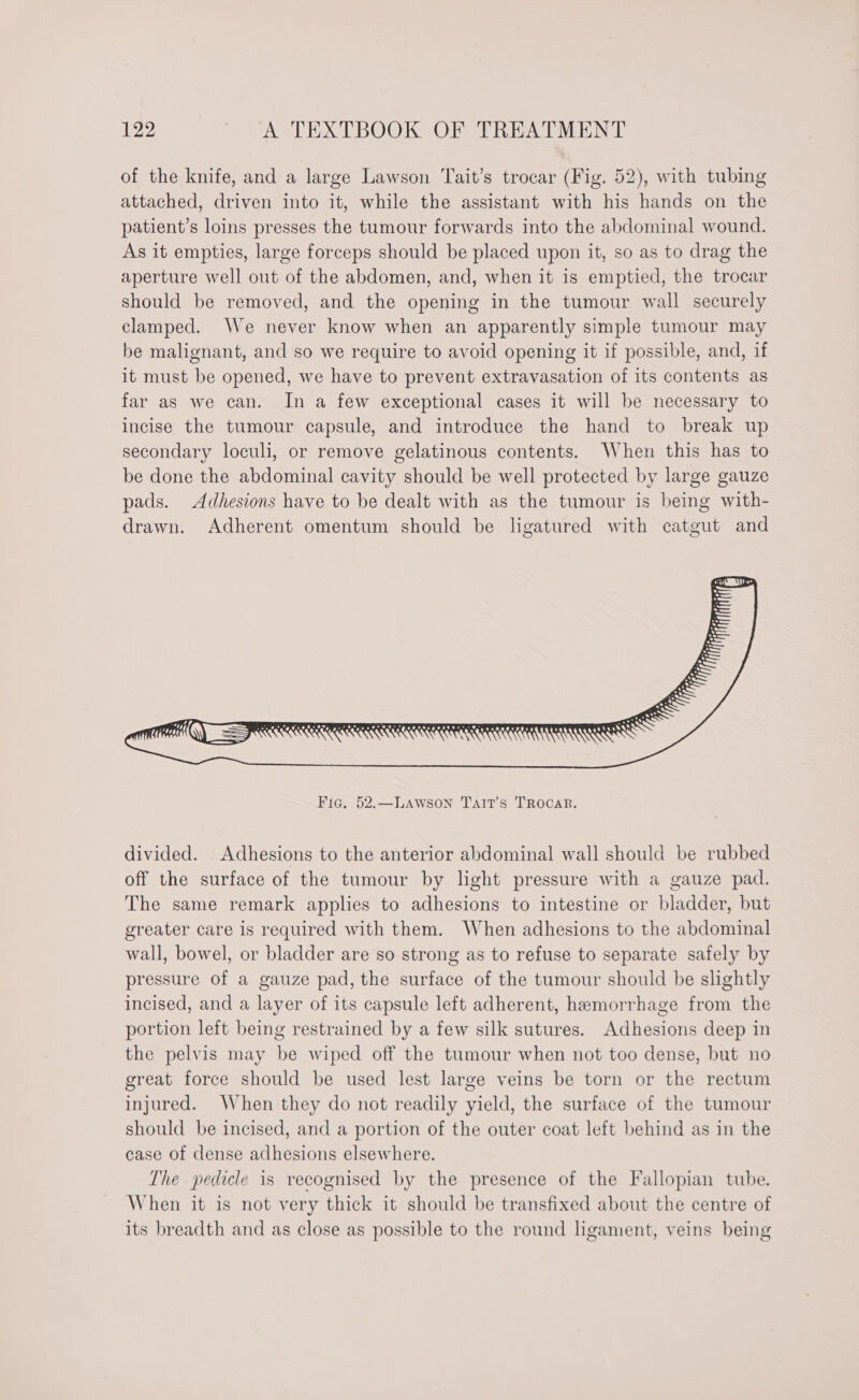 of the knife, and a large Lawson Tait’s trocar (Fig. 52), with tubing attached, driven into it, while the assistant with his hands on the patient’s loins presses the tumour forwards into the abdominal wound. As it empties, large forceps should be placed upon it, so as to drag the aperture well out of the abdomen, and, when it is emptied, the trocar should be removed, and the opening in the tumour wall securely clamped. We never know when an apparently simple tumour may be malignant, and so we require to avoid opening it if possible, and, if it must be opened, we have to prevent extravasation of its contents as far as we can. In a few exceptional cases it will be necessary to incise the tumour capsule, and introduce the hand to break up secondary loculi, or remove gelatinous contents. When this has to be done the abdominal cavity should be well protected by large gauze pads. Adhesions have to be dealt with as the tumour is being with- drawn. Adherent omentum should be ligatured with catgut and divided. Adhesions to the anterior abdominal wall should be rubbed off the surface of the tumour by light pressure with a gauze pad. The same remark applies to adhesions to intestine or bladder, but greater care is required with them. When adhesions to the abdominal wall, bowel, or bladder are so strong as to refuse to separate safely by pressure of a gauze pad, the surface of the tumour should be slightly incised, and a layer of its capsule left adherent, hemorrhage from the portion left being restrained by a few silk sutures. Adhesions deep in the pelvis may be wiped off the tumour when not too dense, but no great force should be used lest large veins be torn or the rectum injured. When they do not readily yield, the surface of the tumour should be incised, and a portion of the outer coat left behind as in the case of dense adhesions elsewhere. The pedicle is recognised by the presence of the Fallopian tube. When it is not very thick it should be transfixed about the centre of its breadth and as close as possible to the round ligament, veins being