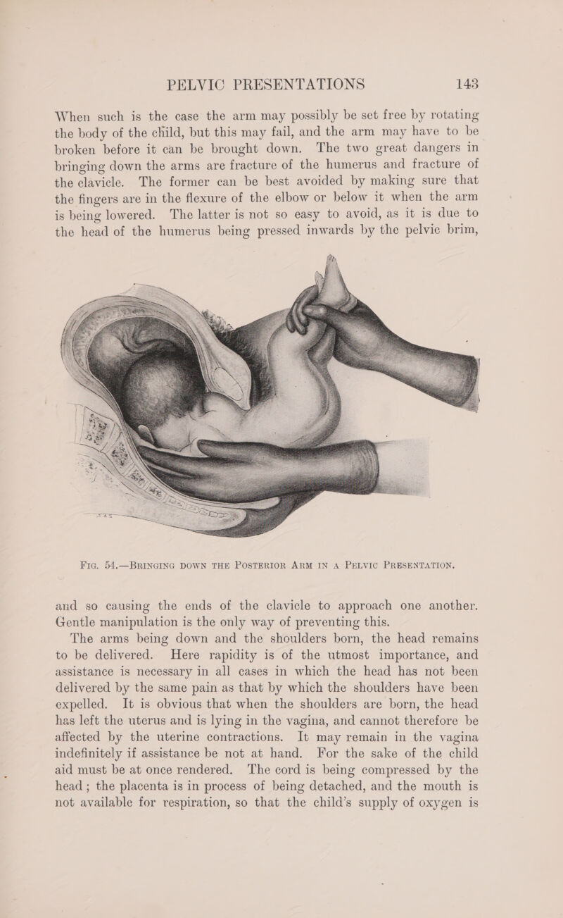 When such is the case the arm may possibly be set free by rotating the body of the child, but this may fail, and the arm may have to be broken before it can be brought down. The two great dangers in bringing down the arms are fracture of the humerus and fracture of the clavicle. The former can be best avoided by making sure that the fingers are in the flexure of the elbow or below it when the arm is being lowered. The latter is not so easy to avoid, as it is due to the head of the humerus being pressed inwards by the pelvic brim, and so causing the ends of the clavicle to approach one another. Gentle manipulation is the only way of preventing this. The arms being down and the shoulders born, the head remains to be delivered. Here rapidity is of the utmost importance, and assistance is necessary in all cases in which the head has not been delivered by the same pain as that by which the shoulders have been expelled. It is obvious that when the shoulders are born, the head has left the uterus and is lying in the vagina, and cannot therefore be affected by the uterine contractions. It may remain in the vagina indefinitely if assistance be not at hand. For the sake of the child aid must be at once rendered. The cord is being compressed by the head ; the placenta is in process of being detached, and the mouth is not available for respiration, so that the child’s supply of oxygen is