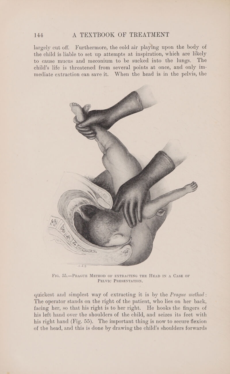 largely cut off. Furthermore, the cold air playing upon the body of the child is liable to set up attempts at inspiration, which are likely to cause mucus and meconium to be sucked into the lungs. The child’s life is threatened from several points at once, and only im- mediate extraction can save it. When the head is in the pelvis, the quickest and simplest way of extracting it is by the Prague method : The operator stands on the right of the patient, who lies on her back, facing her, so that his right is to her right. He hooks the fingers of his left hand over the shoulders of the child, and seizes its feet with his right hand (Fig. 55). The important thing is now to secure flexion of the head, and this is done by drawing the child’s shoulders forwards