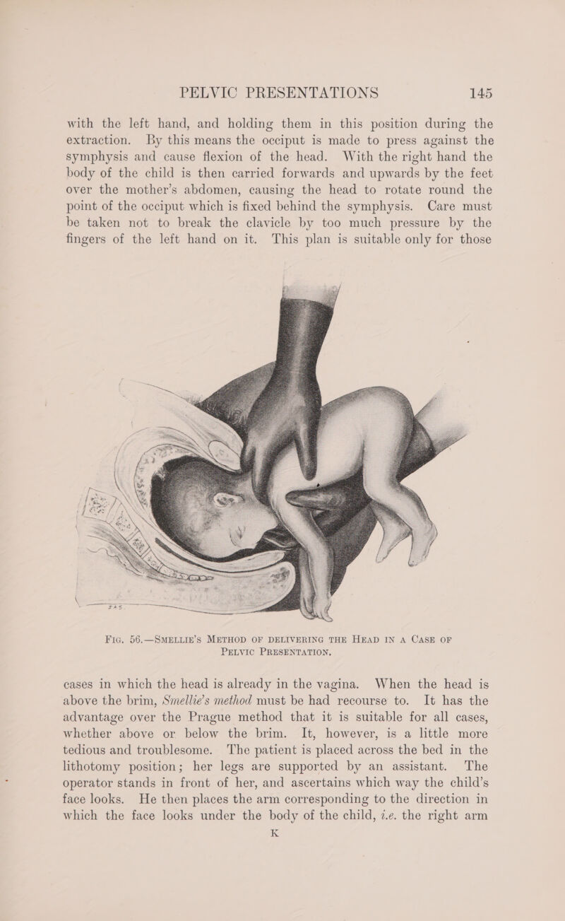 with the left hand, and holding them in this position during the extraction. By this means the occiput is made to press against the symphysis and cause flexion of the head. With the right hand the body of the child is then carried forwards and upwards by the feet over the mother’s abdomen, causing the head to rotate round the point of the occiput which is fixed behind the symphysis. Care must be taken not to break the clavicle by too much pressure by the fingers of the left hand on it. This plan is suitable only for those cases in which the head is already in the vagina. When the head is above the brim, Smellie’s method must be had recourse to. It has the advantage over the Prague method that it is suitable for all cases, whether above or below the brim. It, however, is a little more tedious and troublesome. The patient is placed across the bed in the lithotomy position; her legs are supported by an assistant. The operator stands in front of her, and ascertains which way the child’s face looks. He then places the arm corresponding to the direction in which the face looks under the body of the child, ze. the right arm K