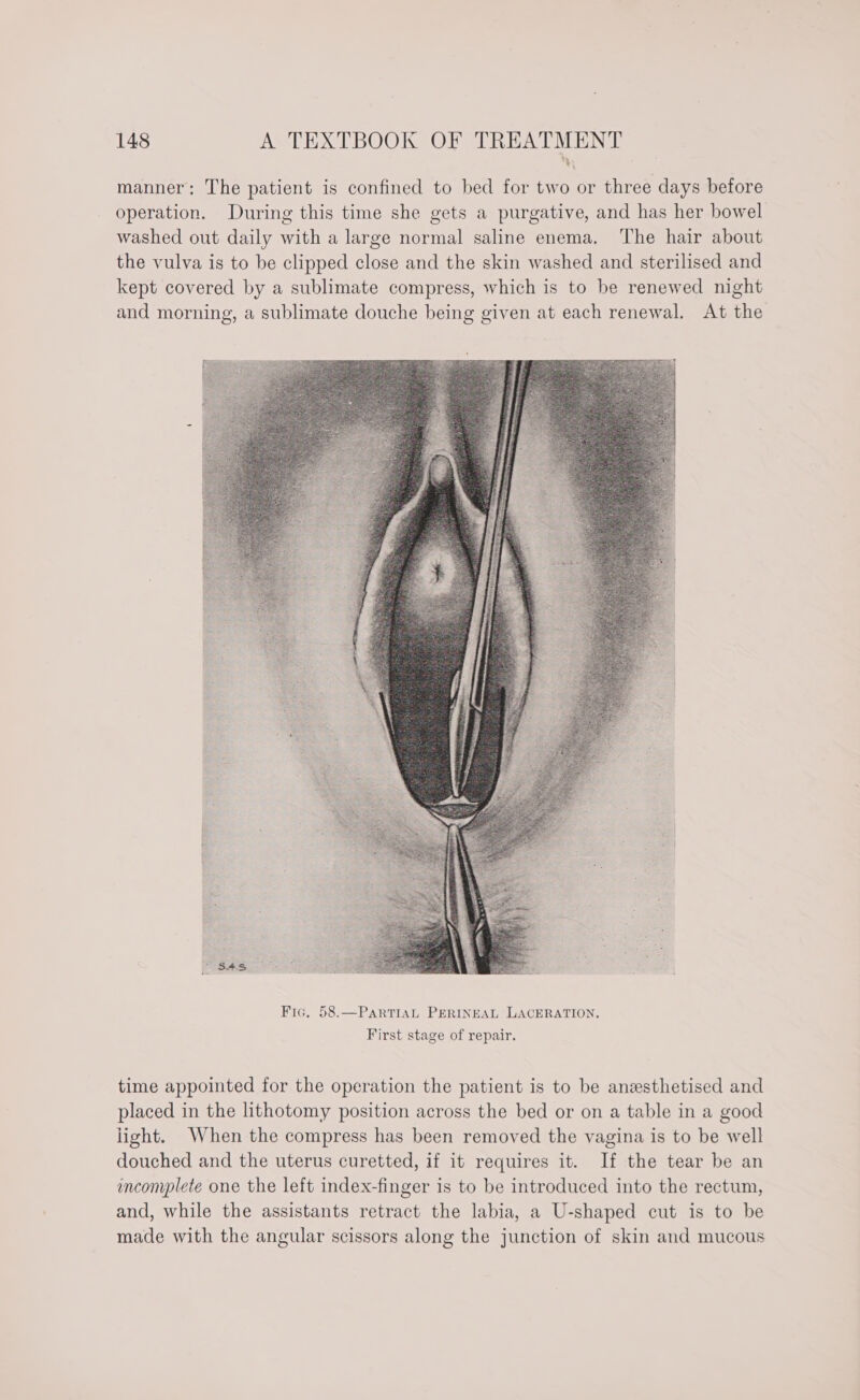 manner: The patient is confined to bed for two or three days before operation. During this time she gets a purgative, and has her bowel washed out daily with a large normal saline enema. The hair about the vulva is to be clipped close and the skin washed and sterilised and kept covered by a sublimate compress, which is to be renewed night and morning, a sublimate douche being given at each renewal. At the time appointed for the operation the patient is to be ansthetised and placed in the lithotomy position across the bed or on a table in a good light. When the compress has been removed the vagina is to be well douched and the uterus curetted, if it requires it. If the tear be an incomplete one the left index-finger is to be introduced into the rectum, and, while the assistants retract the labia, a U-shaped cut is to be made with the angular scissors along the junction of skin and mucous