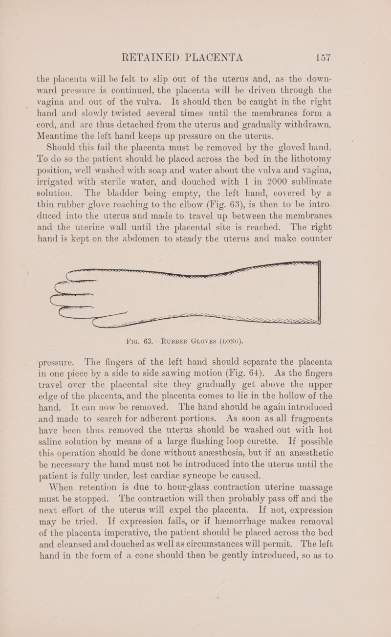 RETAINED PLACENTA fon the placenta will be felt to slip out of the uterus and, as: the down- ward pressure is continued, the placenta will be driven through the vagina and out of the vulva. It should then be caught in the right hand and slowly twisted several times until the membranes form a cord,.and are thus detached from the uterus and gradually withdrawn. Meantime the left hand keeps up pressure on the uterus. Should this fail the placenta must be removed by the gloved hand. To do so the patient should be placed across the bed in the lithotomy position, well washed with soap and water about the vulva and vagina, irrigated with sterile water, and douched with 1 in 2000 sublimate solution. The bladder being empty, the left hand, covered by a thin rubber glove reaching to the elbow (Fig. 63), is then to be intro- duced into the uterus and made to travel up between the membranes and the uterine wall until the placental site is reached. The right hand is kept on the abdomen to steady the uterus and make counter = = ———— Fic. 63.—RUBBER GLOVES (LONG). pressure. The fingers of the left hand should separate the placenta in one piece by a side to side sawing motion (Fig. 64). As the fingers travel over the placental site they gradually get above the upper edge of the placenta, and the placenta comes to lie in the hollow of the hand. It can now be removed. ‘The hand should be again introduced and made to search for adherent portions. As soon as all fragments have been thus removed the uterus should be washed out with hot saline solution by means of a large flushing loop curette. If possible this operation should be done without anesthesia, but if an anesthetic be necessary the hand must not be introduced into the uterus until the patient is fully under, lest cardiac syncope be caused. When retention is due to hour-glass contraction uterine massage must be stopped. The contraction will then probably pass off and the next effort of the uterus will expel the placenta. If not, expression may be tried. If expression fails, or if hemorrhage makes removal of the placenta imperative, the patient should be placed across the bed and cleansed and douched as well as circumstances will permit. The left hand in the form of a cone should then be gently introduced, so as to